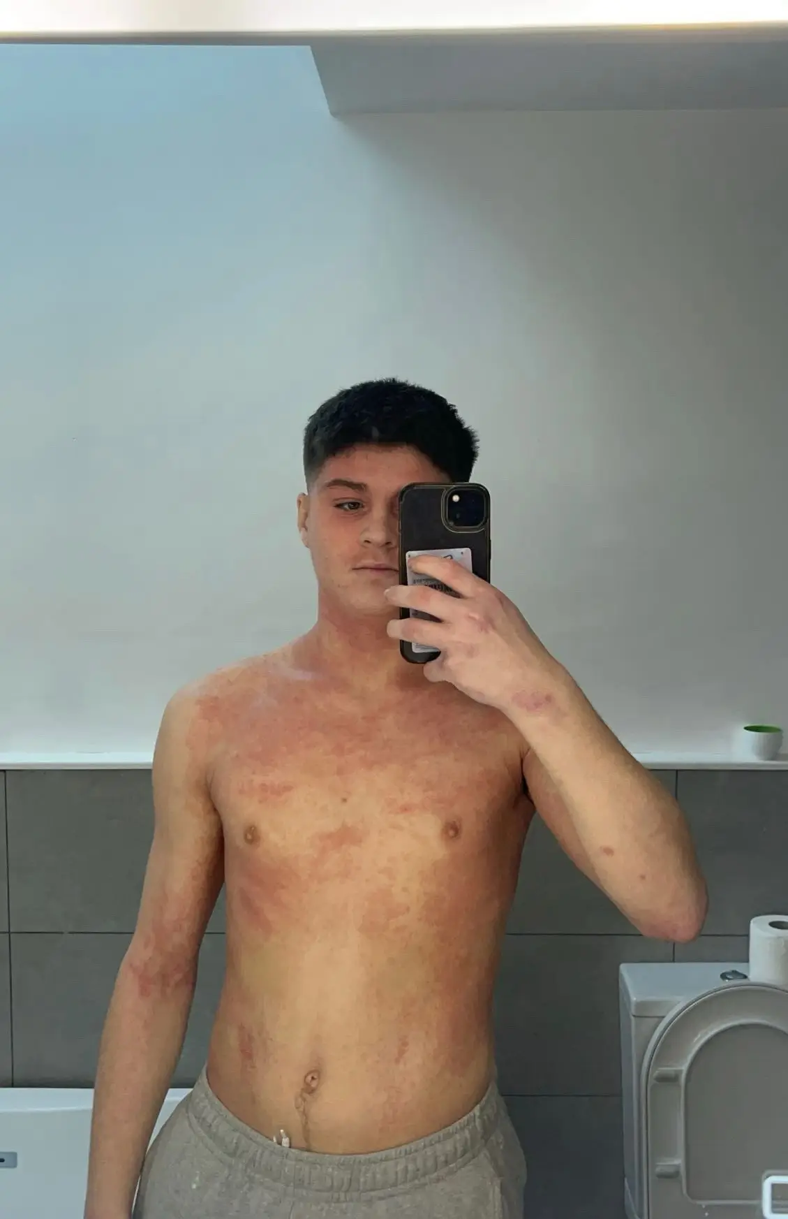 Rowlands eczema was worse than ever before (GoFundMe)