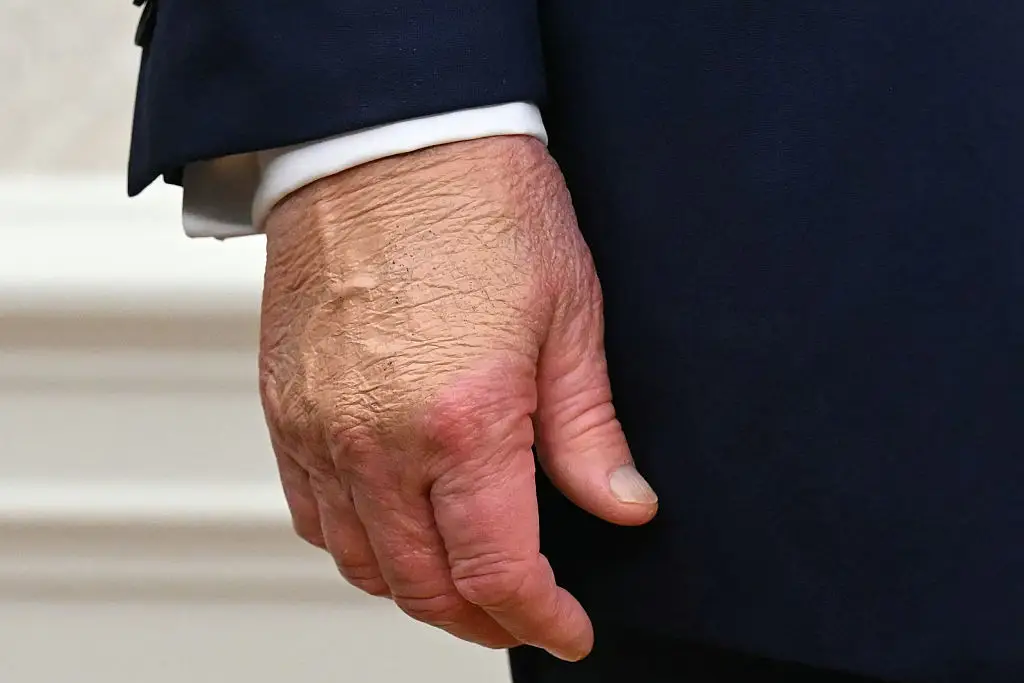 The president sparked concern when people spotted what appeared to be bruises covered in make-up on his hand (SAUL LOEB/AFP via Getty Images)
