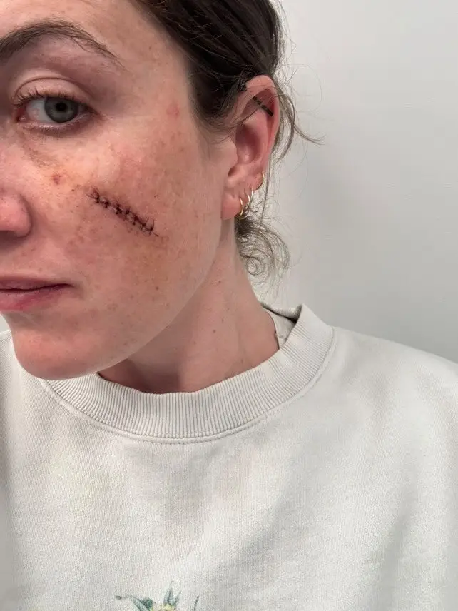 The mum, from Melbourne, had to undergo surgery to remove the sebaceous cyst (SWNS)