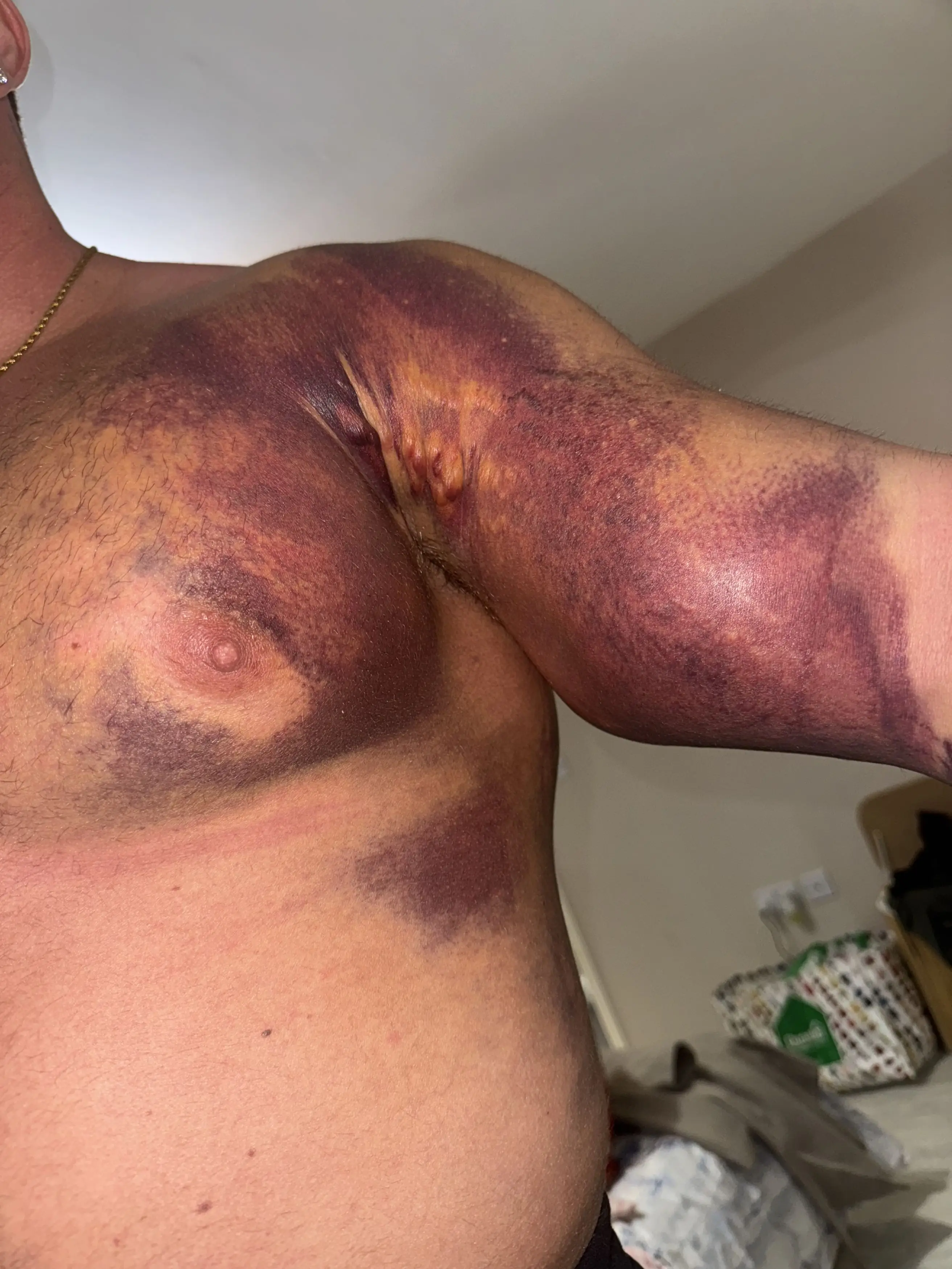 He might need surgery to repair the damage done to his pec (Kennedy/@Ttristbarnes)