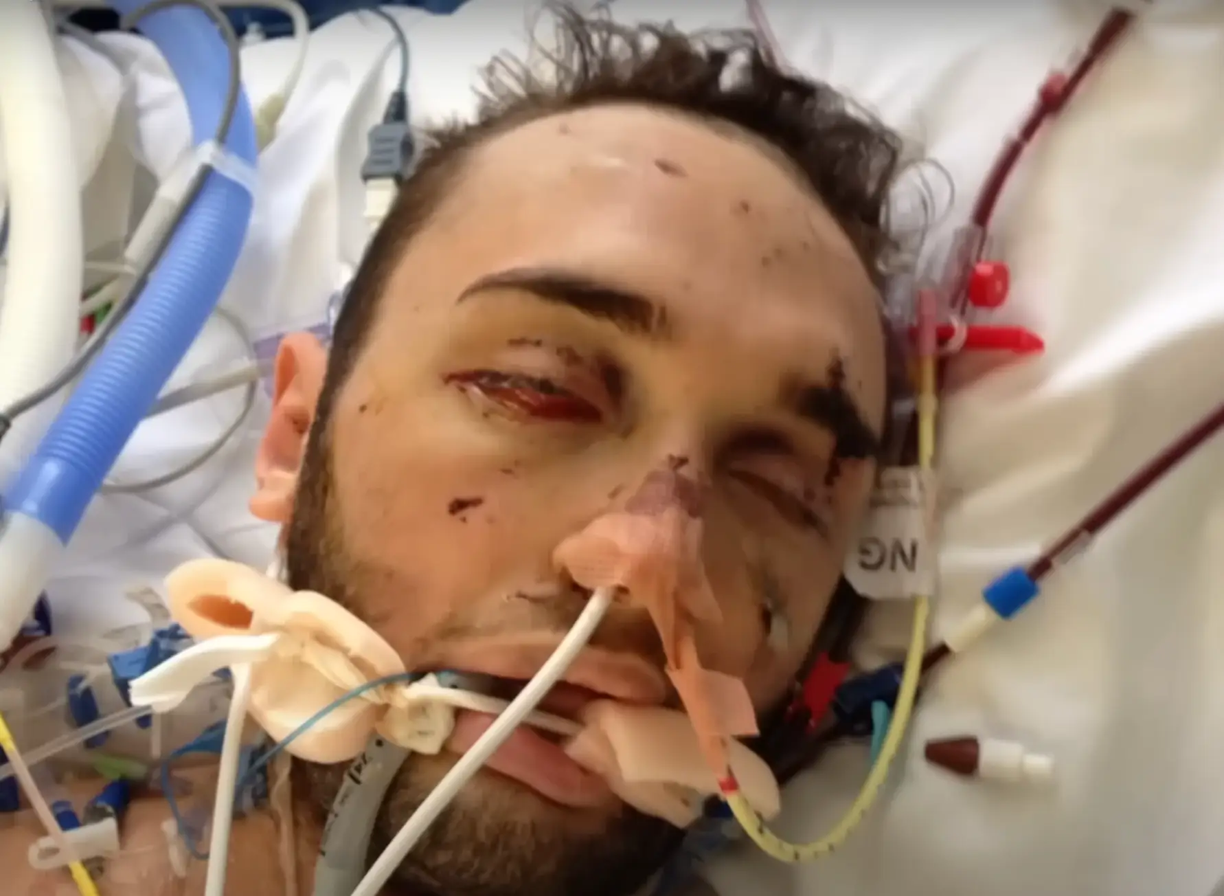 He was in a coma for four months after his crash (Channel 4)
