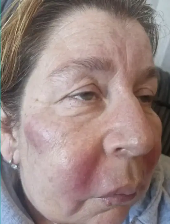The 59-year-old explained she received dermal fillers from an unlicensed practitioner who she found on Facebook (ITV/This Morning)