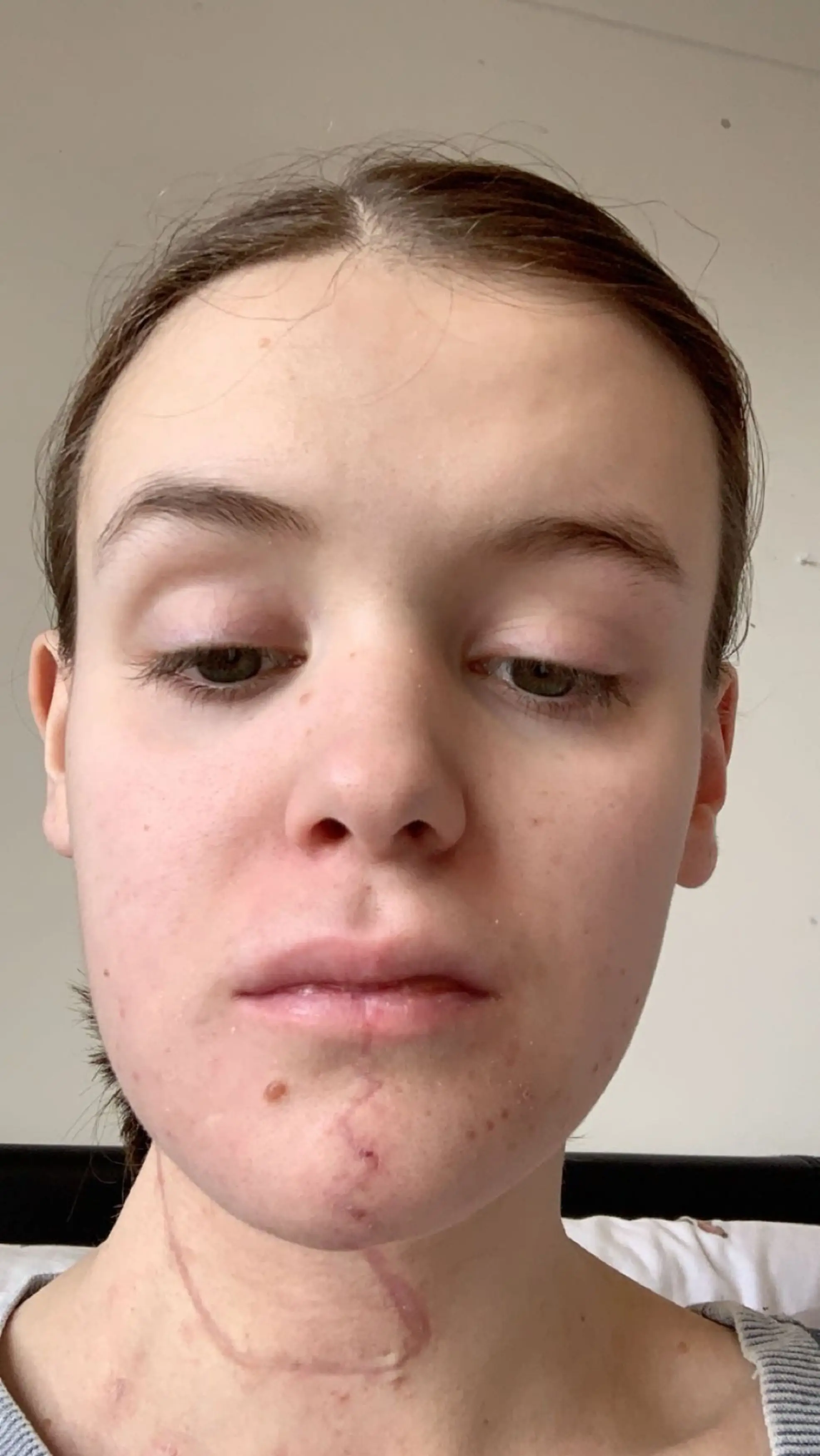 Morton feels proud of her scars, as they show what she's been through.