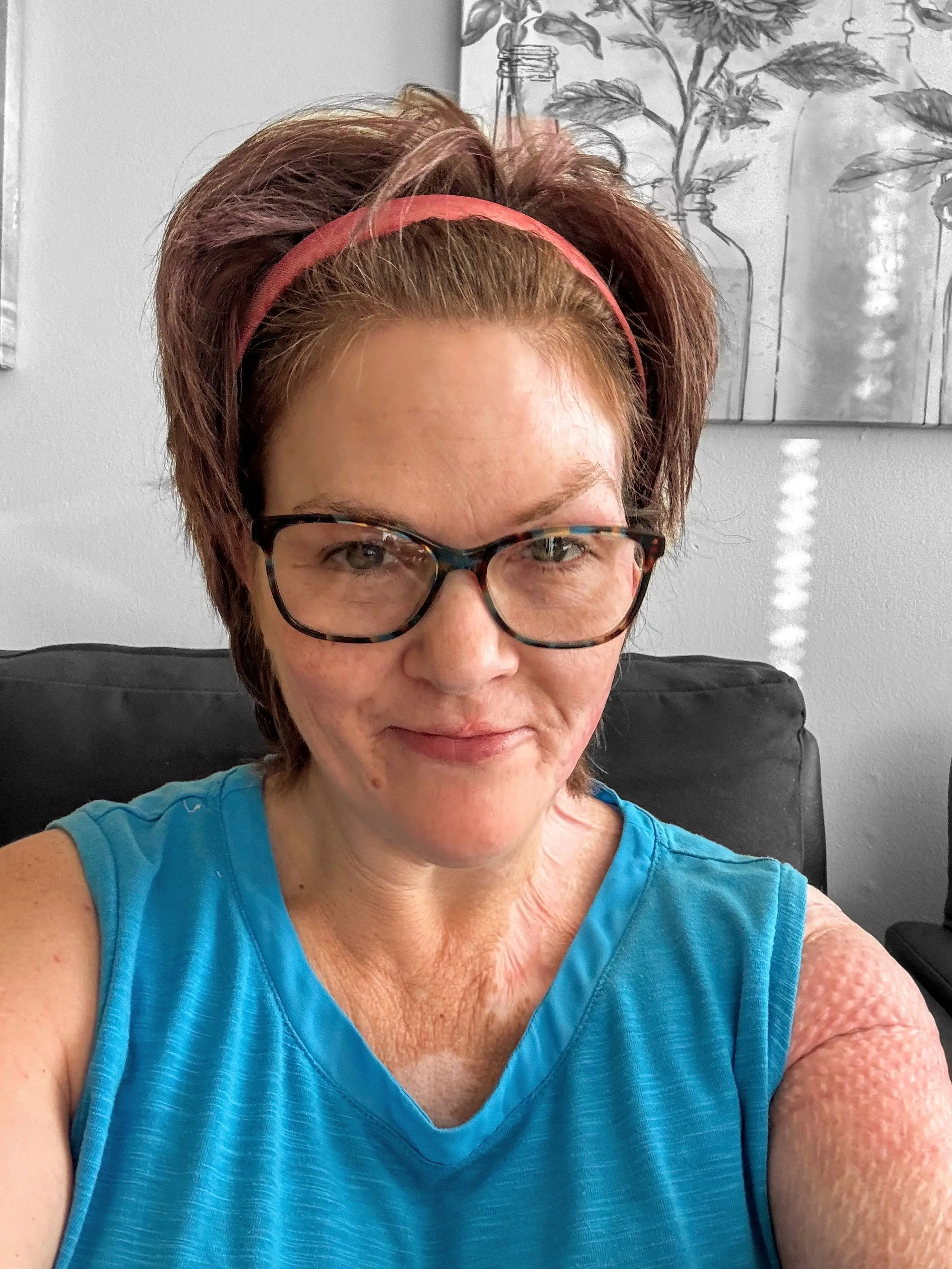 Cherylee has undergone 15 operations to treat the burns after her first vape exploded (Kennedy News and Media)