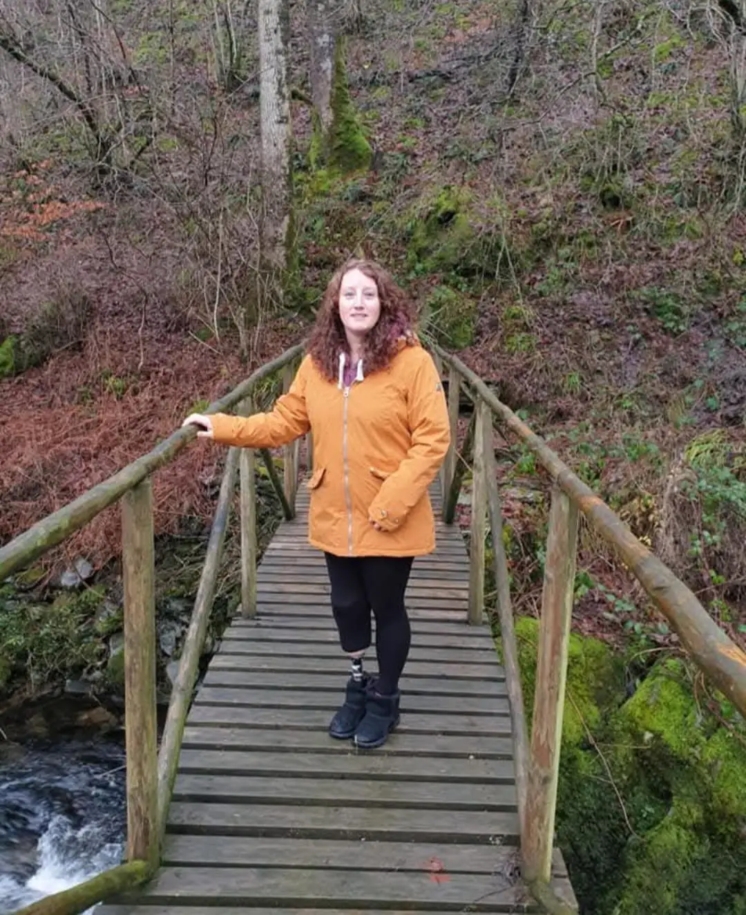 Gill Haddington after having her right lower leg amputated (SWNS)