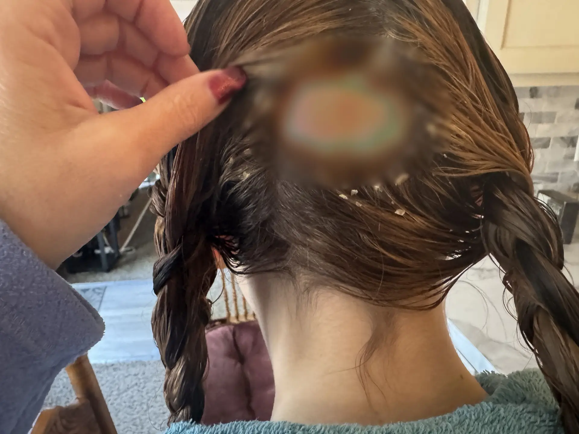 The chemicals burned through her skin (Kennedy News and Media)