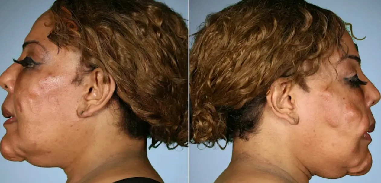 She had concrete 'nodules' in her face due to the dodgy injections (E!)