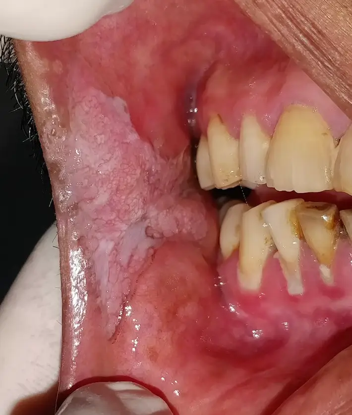 Snus can cause cancer, though the risk is lower than that of smoking cigarettes (BMJ)