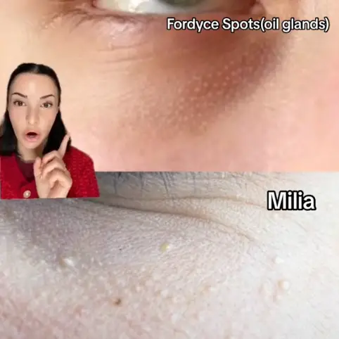 Fordyce spots are small, painless white bumps (TikTok/@cheboclinic)
