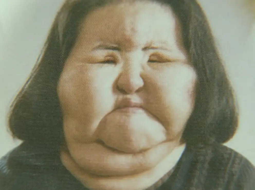 Hang Mioku at the height of her plastic surgery addiction (SBS)