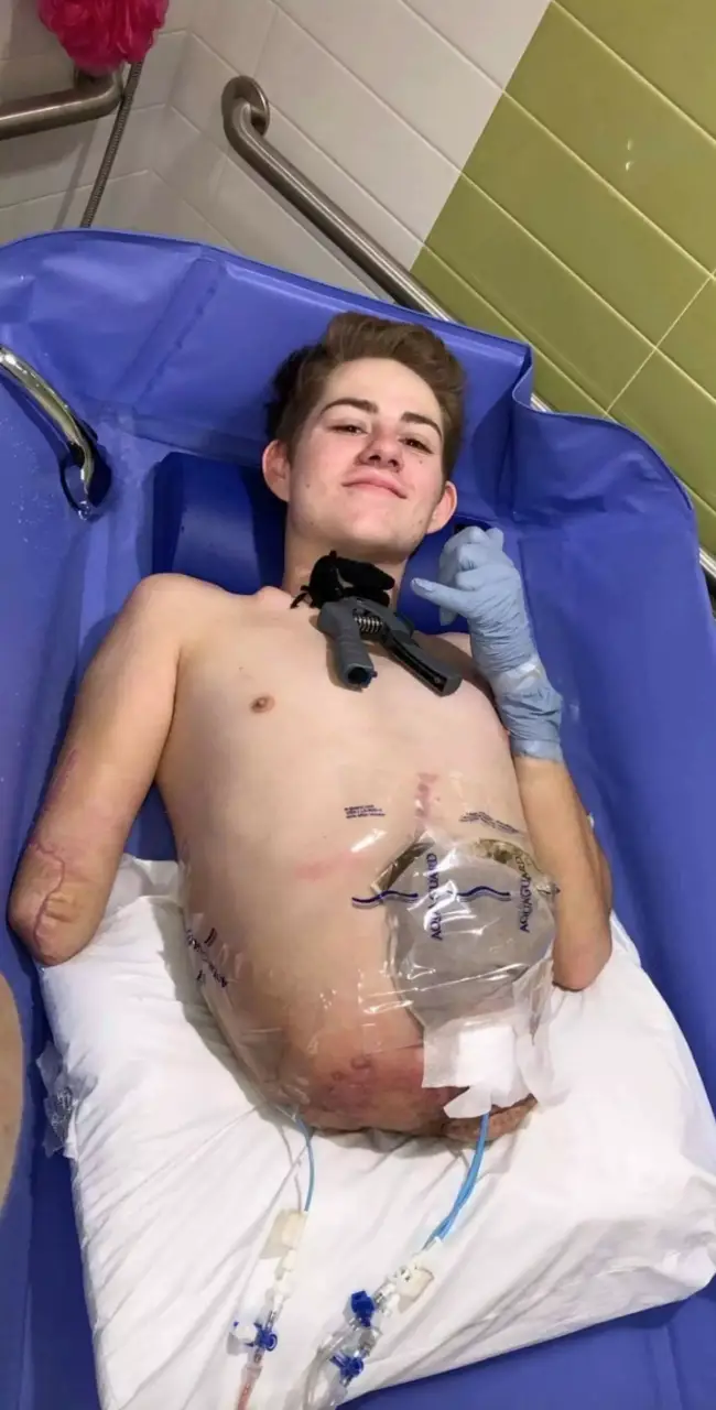 Loren Schauers underwent the amputation of everything below his waist after a forklift landed on him (SWNS)