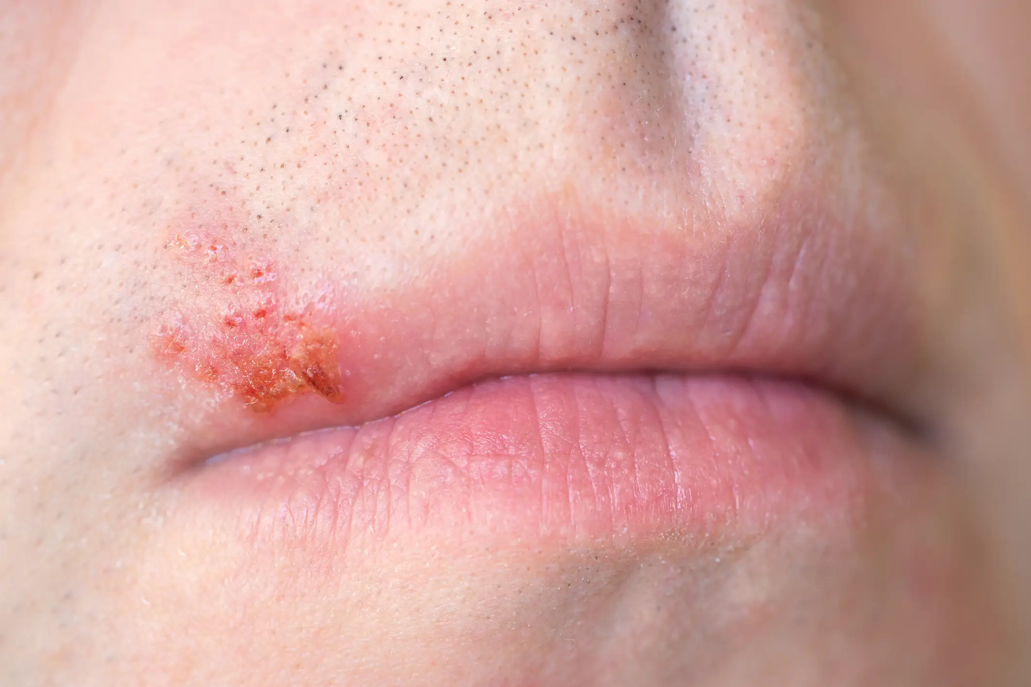 Herpes can present itself on your mouth and lips (Getty Stock)