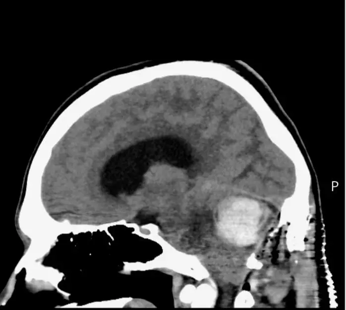 Luke's brain tumour was huge but thankfully benign and non-cancerous (SWNS)