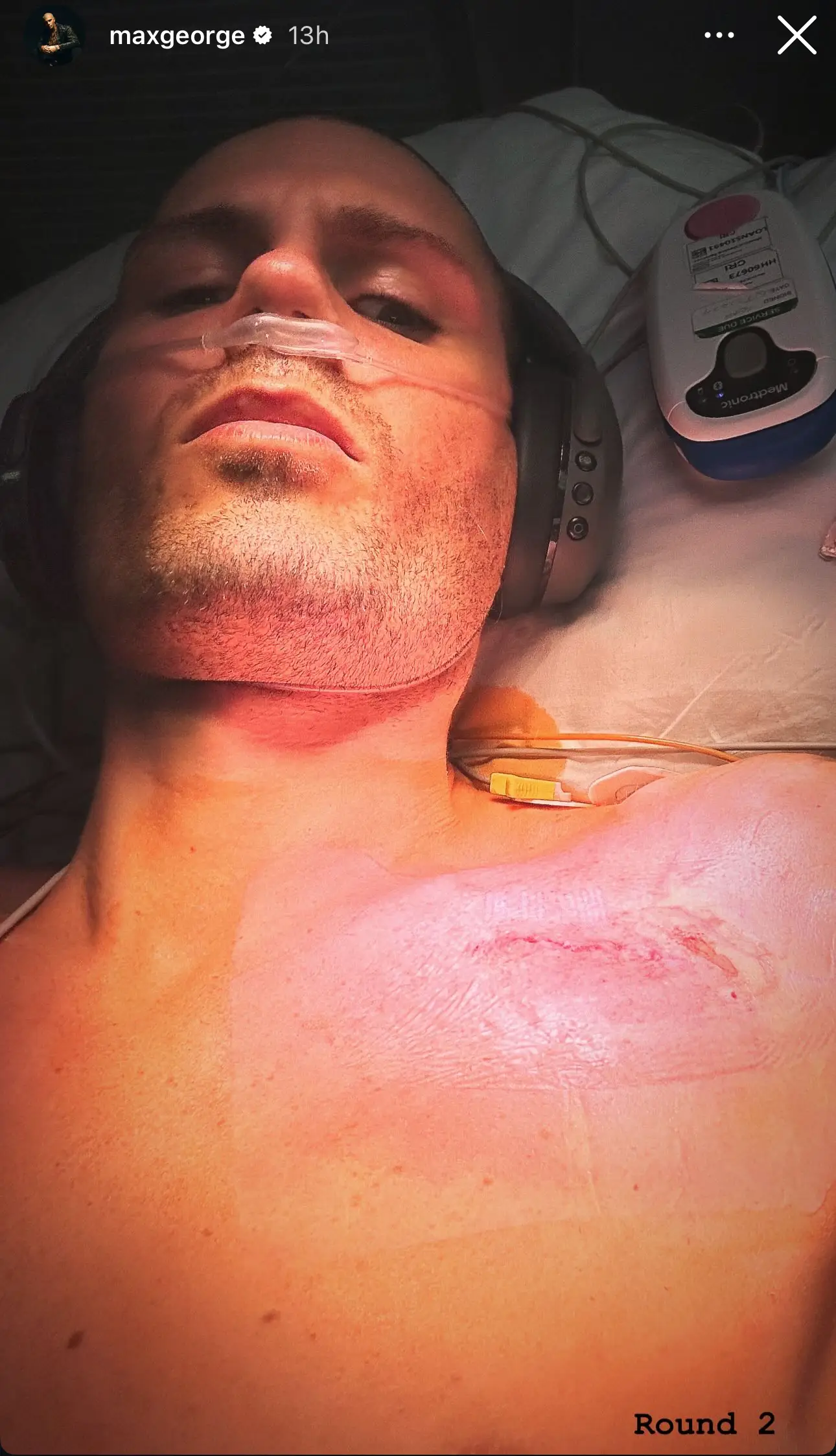 Max George has given fans another health update (Instagram/ MaxGeorge)