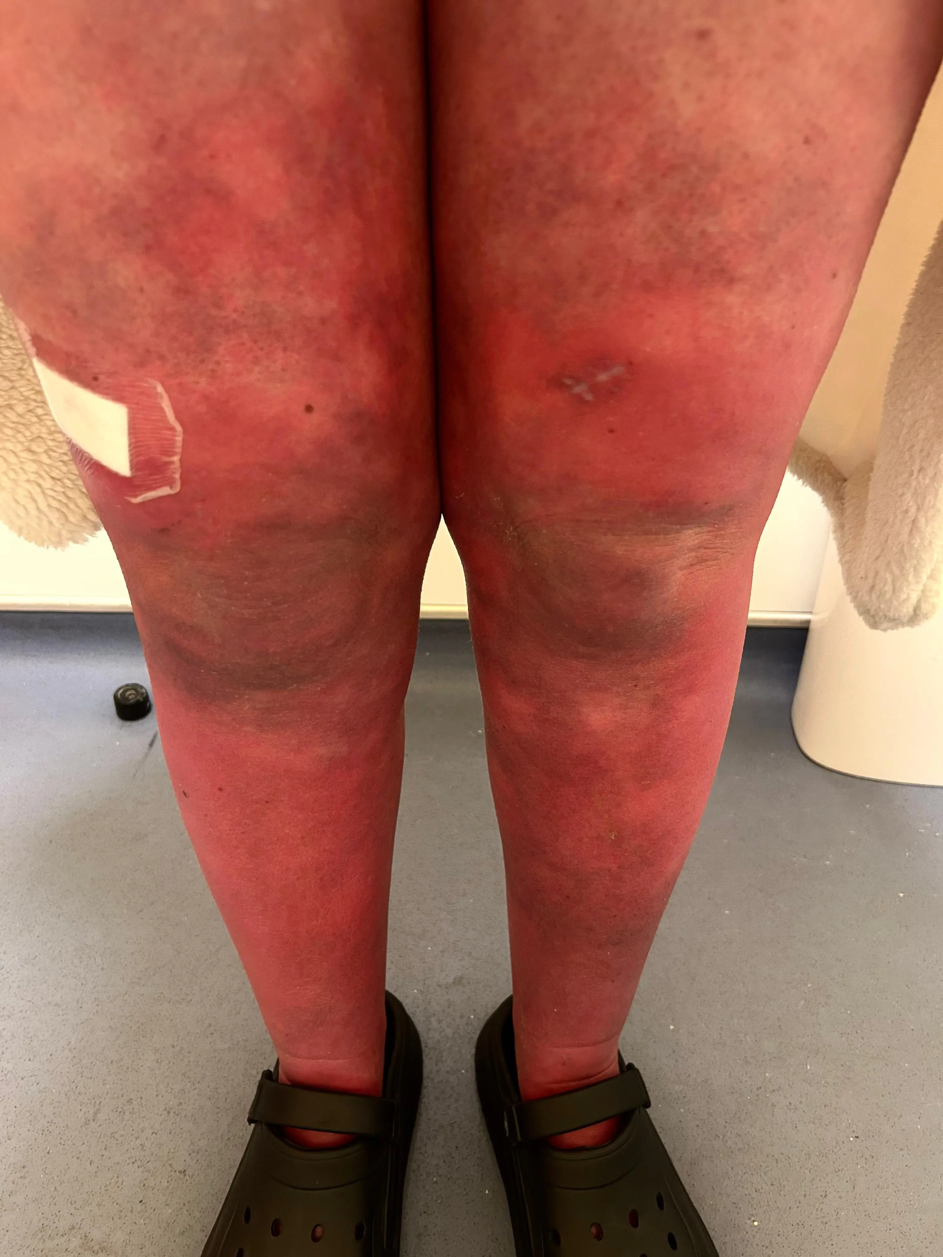 Rachel's condition only got worse as the pregnancy continued (PA)