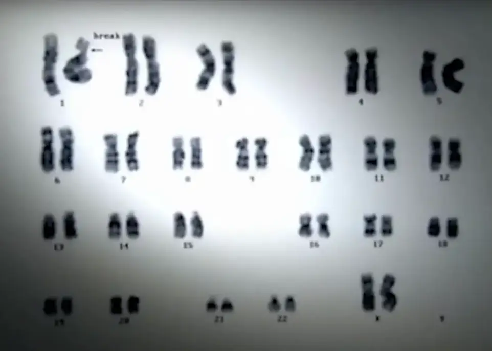 Alterations of Ouchi's DNA, caused by the fatal radiation dose (NHK)