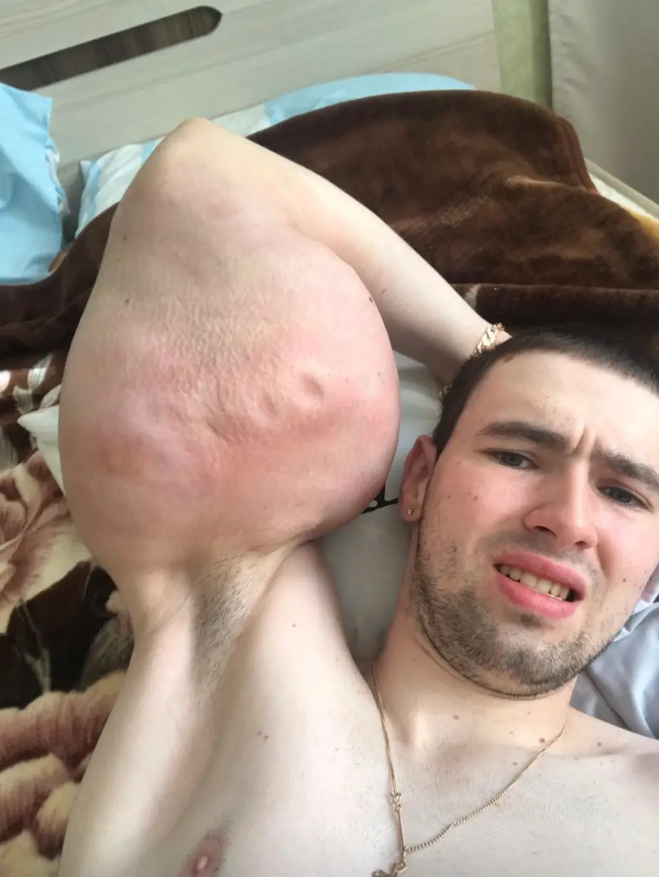 Kirill Tereshin's bulging artificial biceps have landed him in hospital (Instagram/@ruki_bazuki_official)