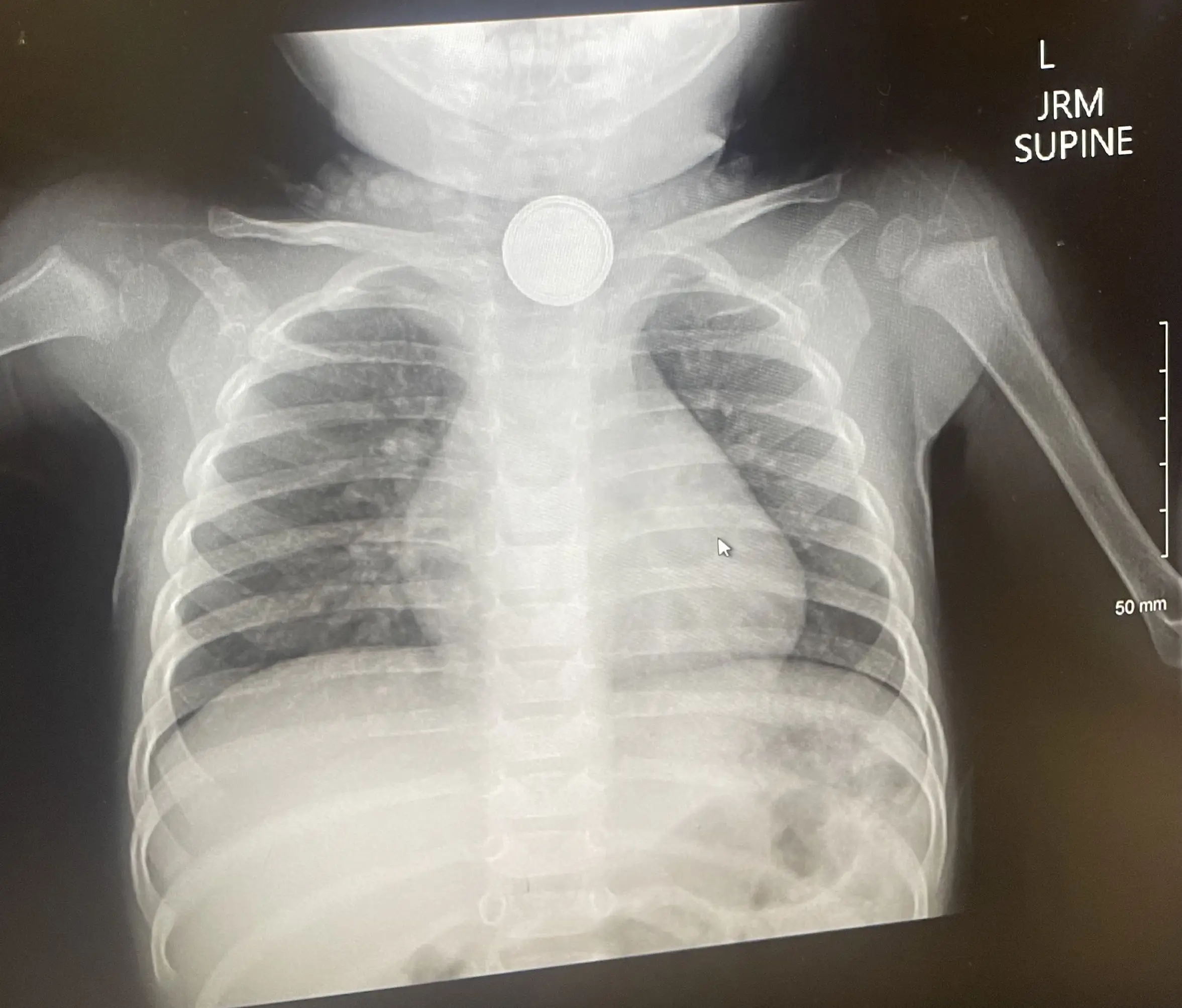 The harrowing X-ray revealed the worst (Kennedy News and Media)