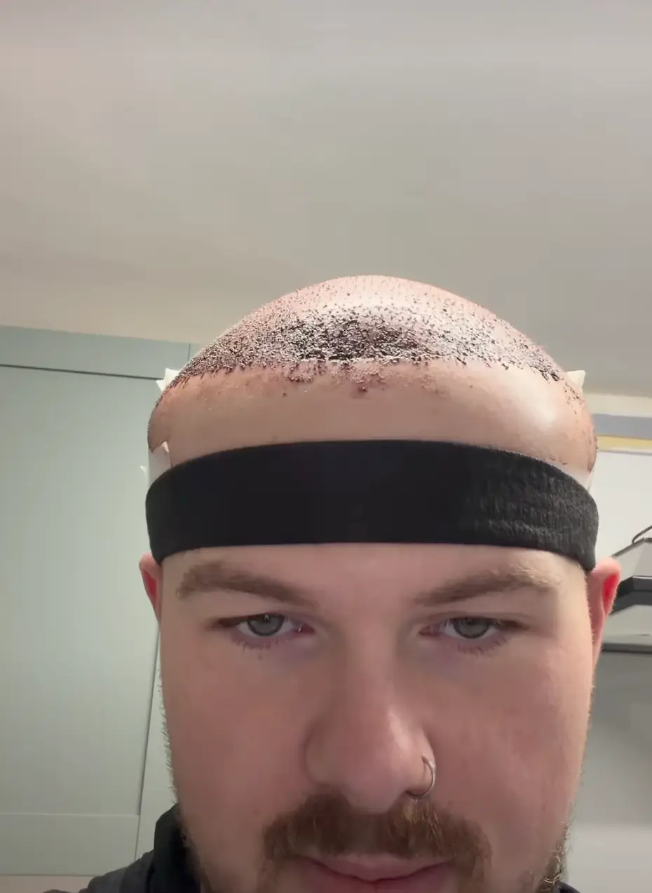 Leo experienced a lot of swelling after the operation (Instagram/cuts_by_lb)