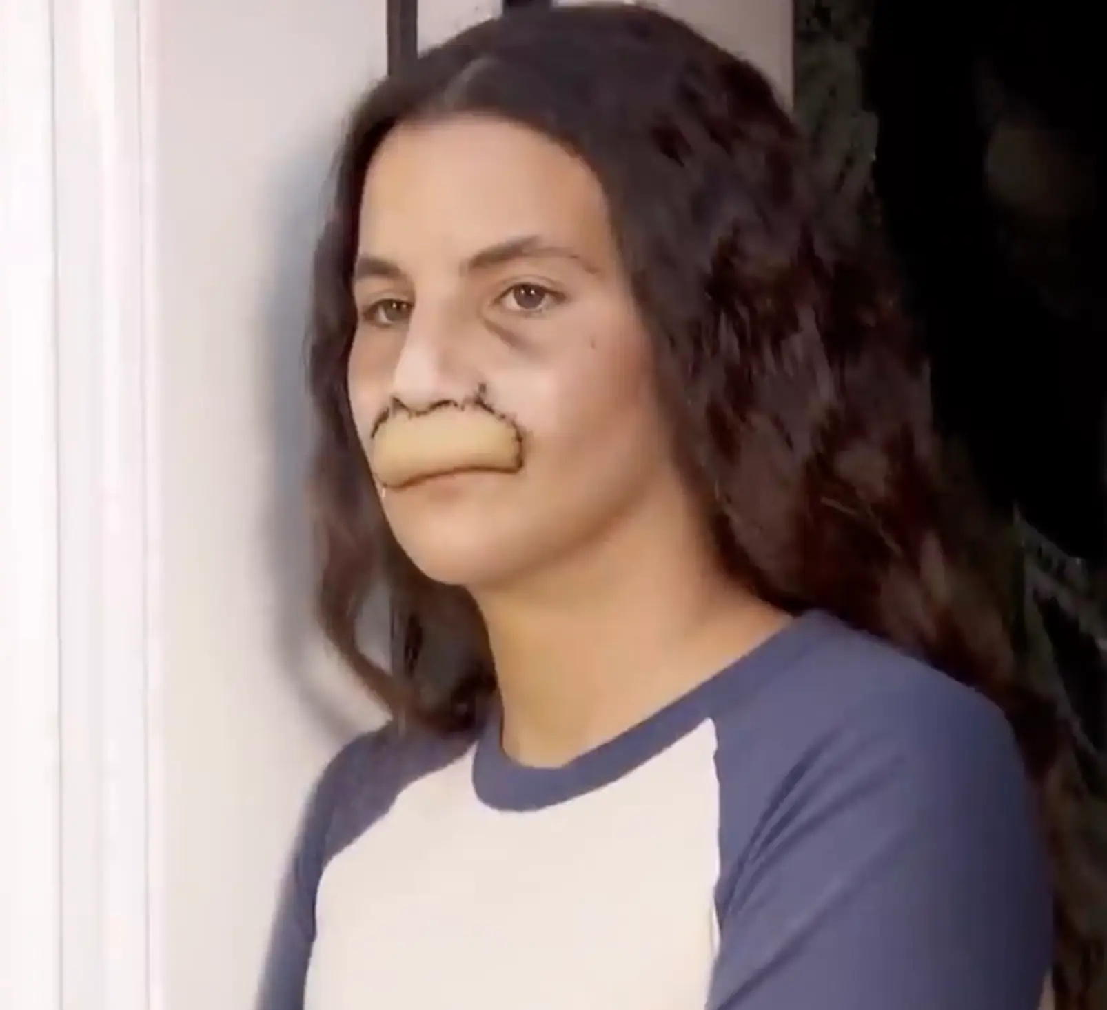 Brooklinn was attacked by her cousin's dog. (Inside Edition)