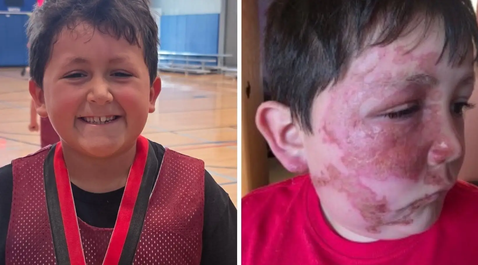 Caleb Chabolla, nine, suffered burns to his face after putting his Nee Doh Cubes in the microwave (Loyola Medicine)