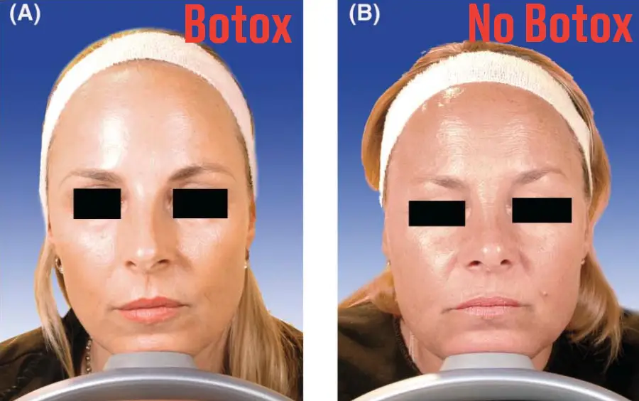 A follow-up study took place six years later (American Society for Dermatologic Surgery)