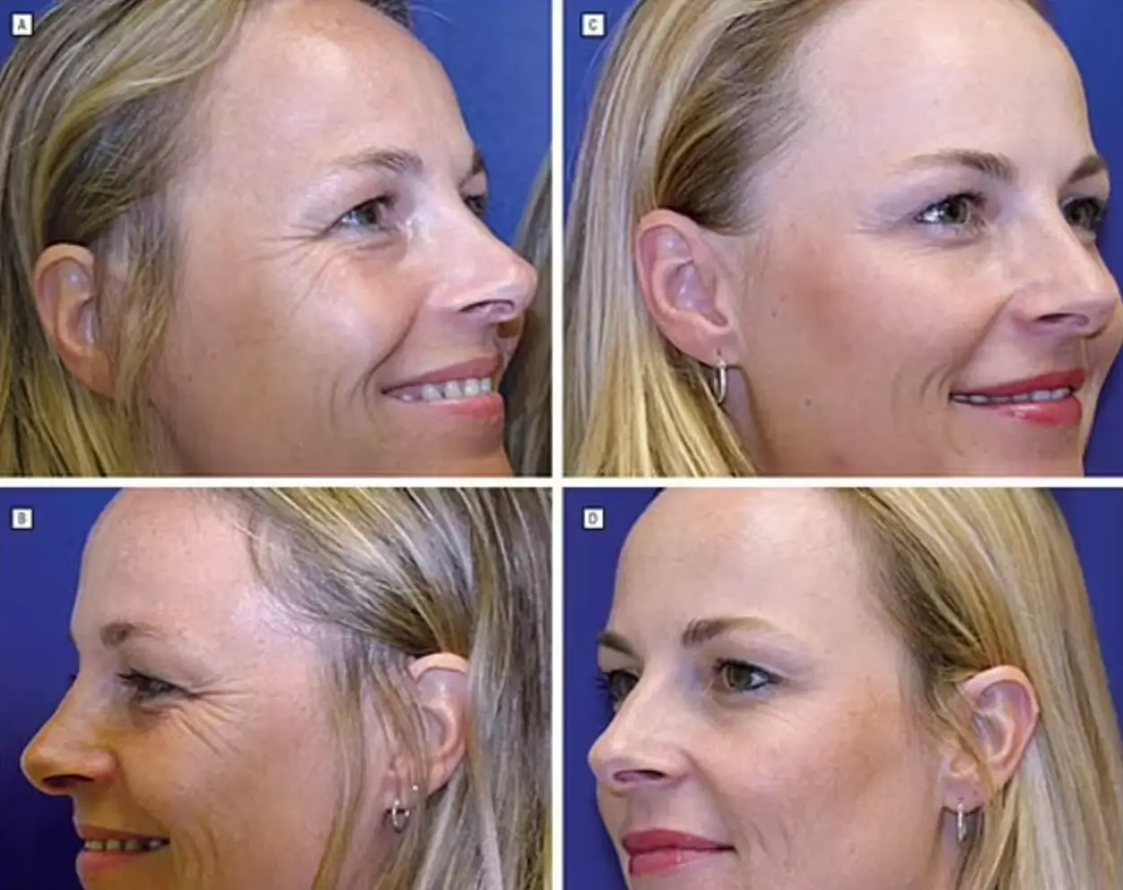 Images A and B show the results of the non-botox twin, while Images C and D reveal the differences with the Botox twin (American Medical Association)