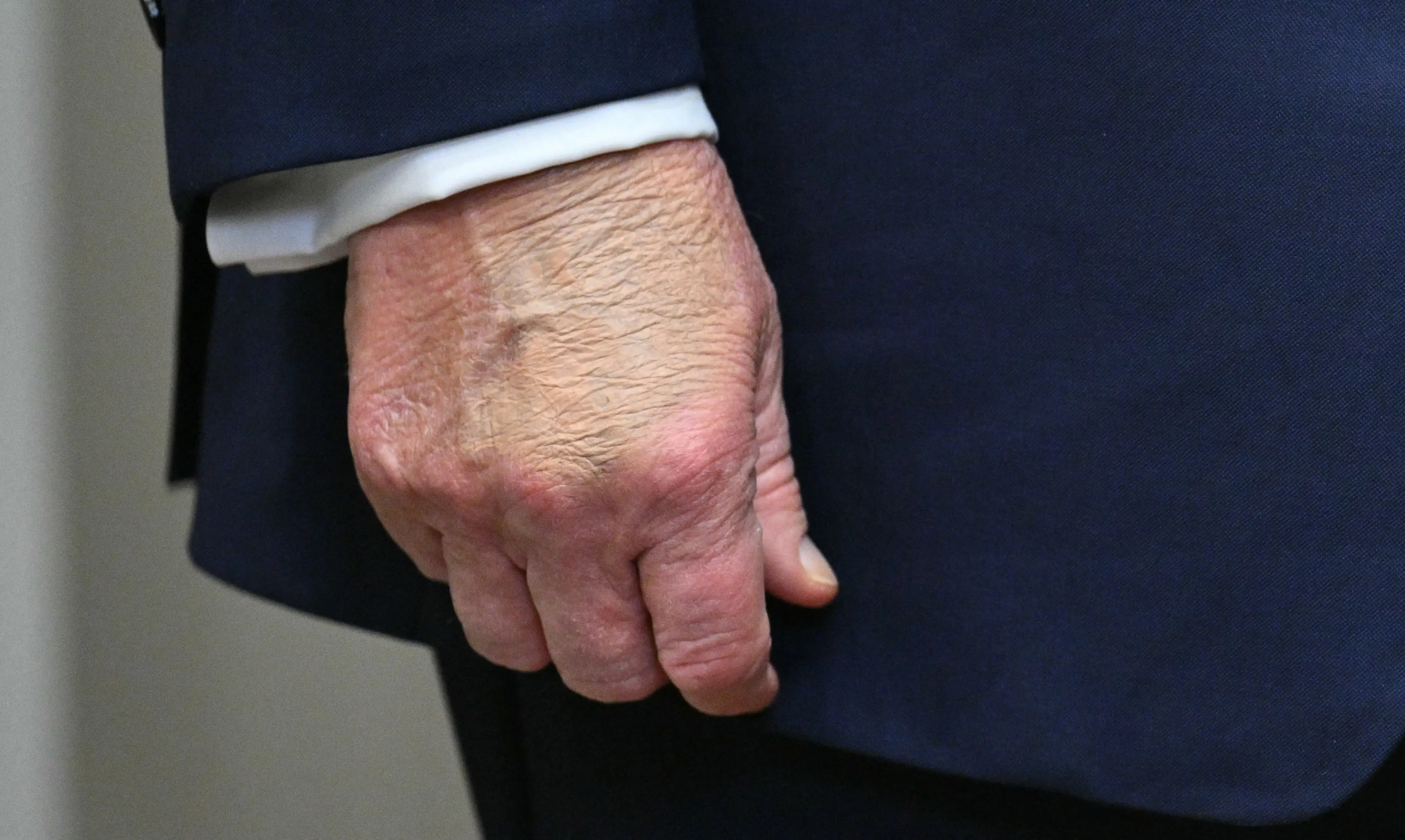 The large bruise on his right hand also remained visible on Monday (ROBERTO SCHMIDT/AFP via Getty Images)