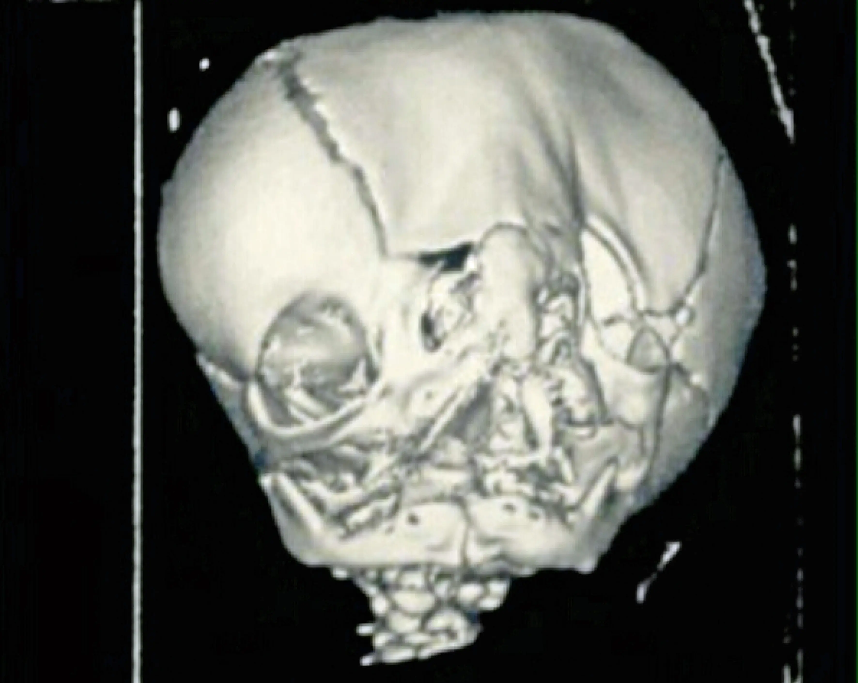 Only 36 people in the world have Tres' condition.