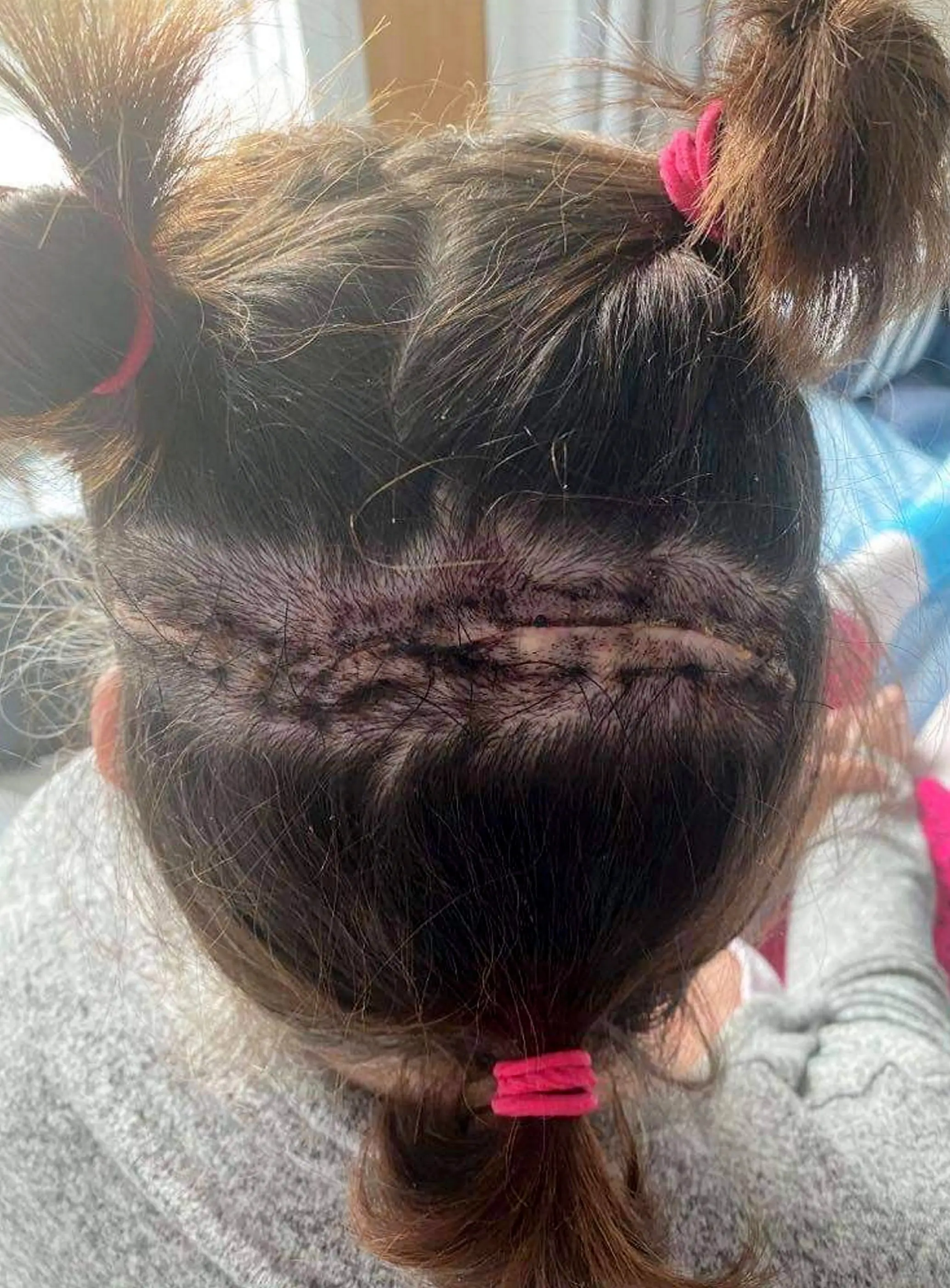 It was an infection that followed a clinical trial. (SWNS)