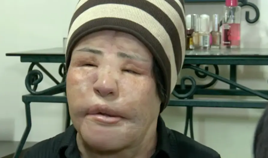 Injecting cooking oil can lead to masses under the skin (SBS)