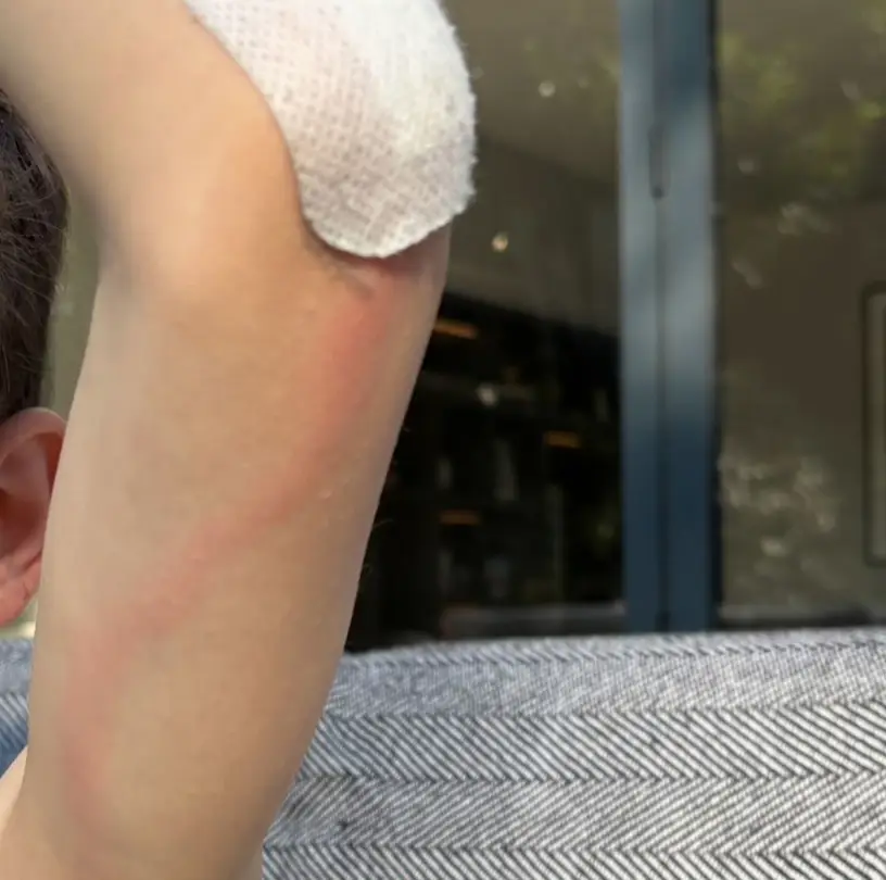 The red line coming from his grazed elbow made her think she should take her son to A&E, it turned out to be the right decision (Samantha Silver)