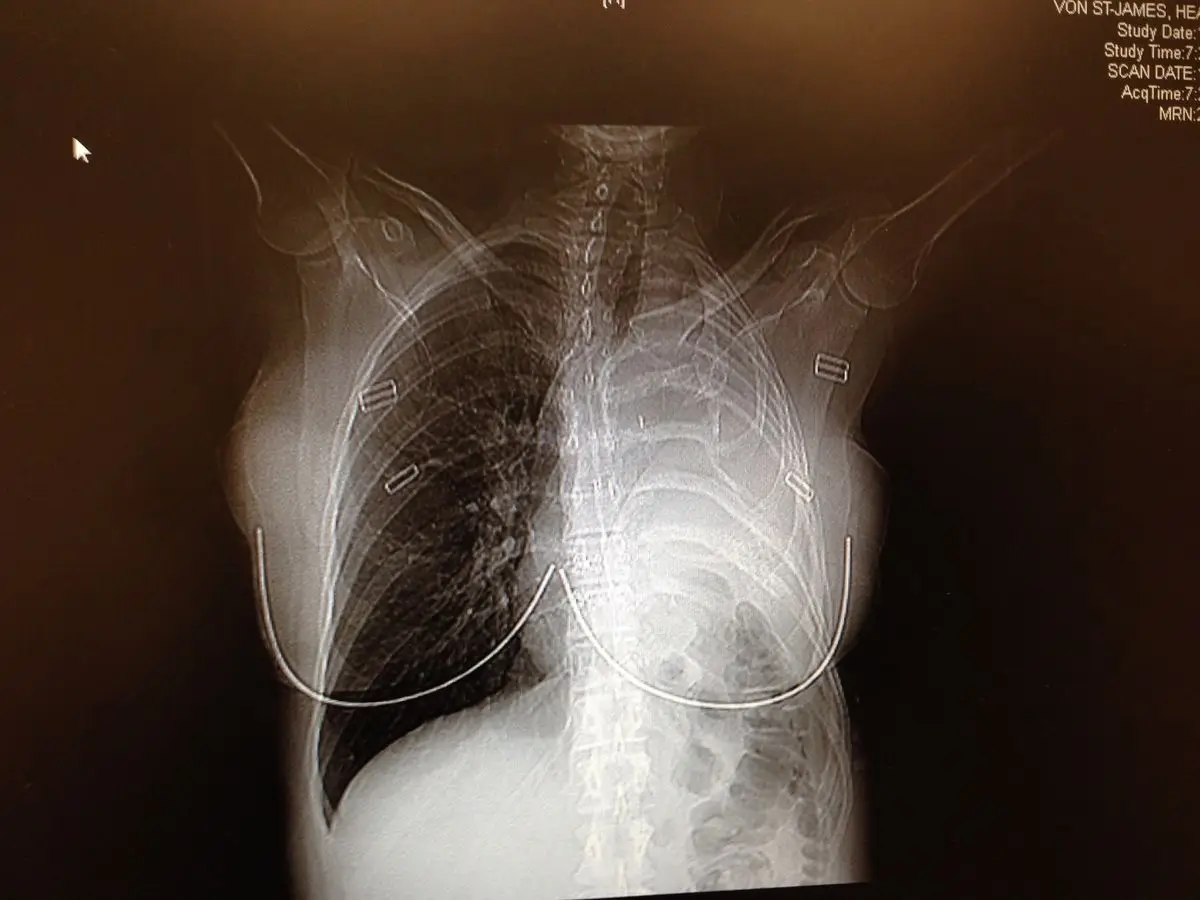 Heather had to undergo a risky surgery to have the tumour removed (Cover Images)