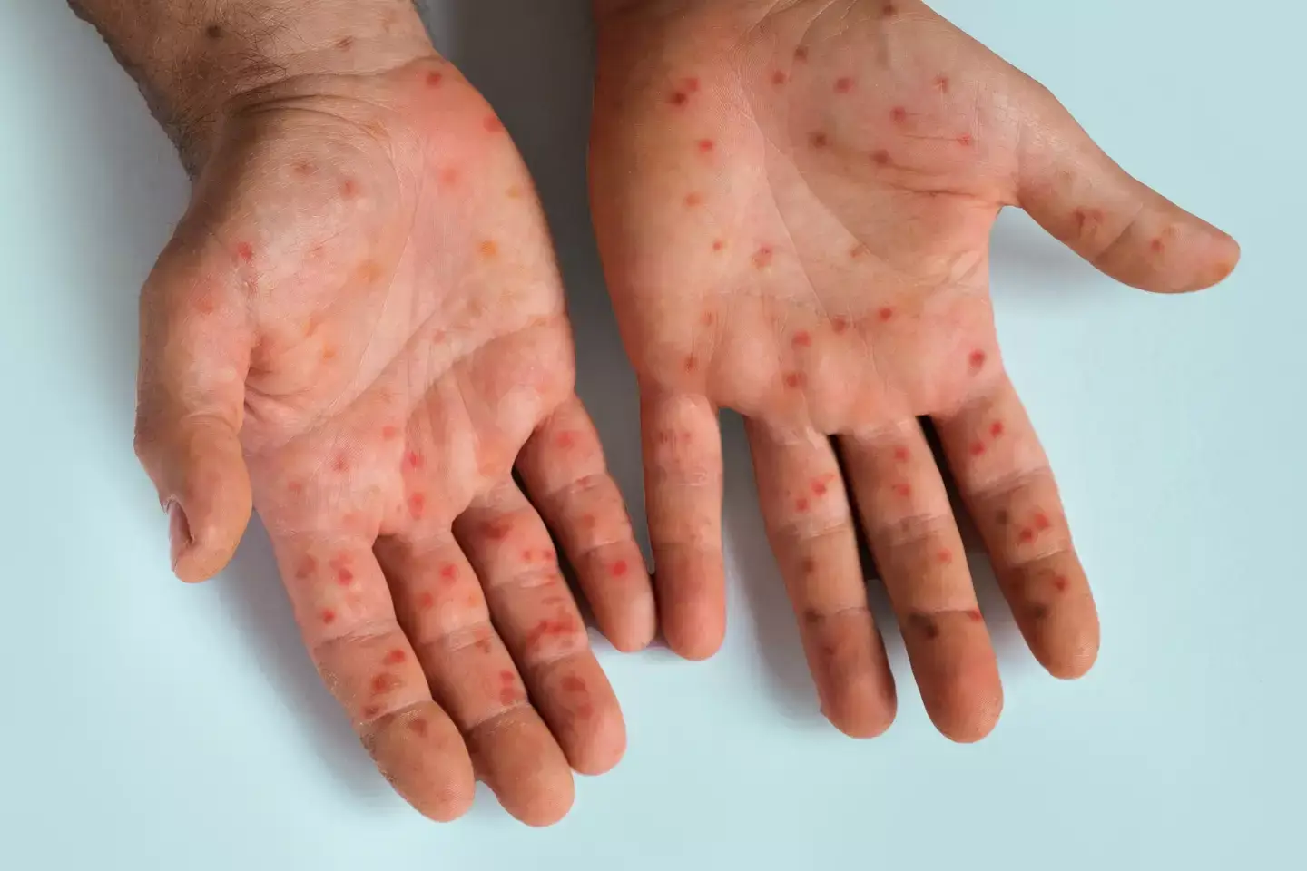 A rash is one of the early symptoms of mpox (Getty Stock Images)
