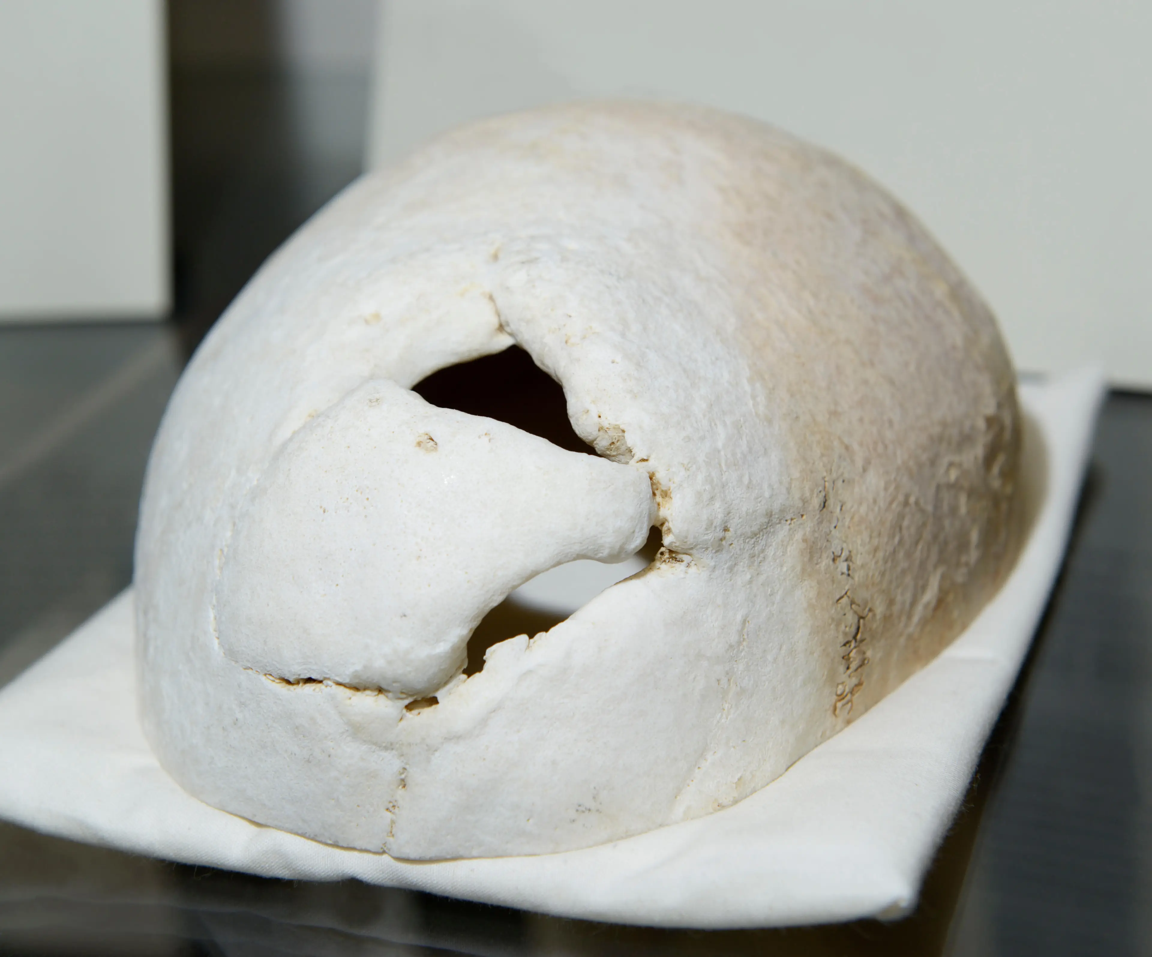 Gage's skull is now on display.