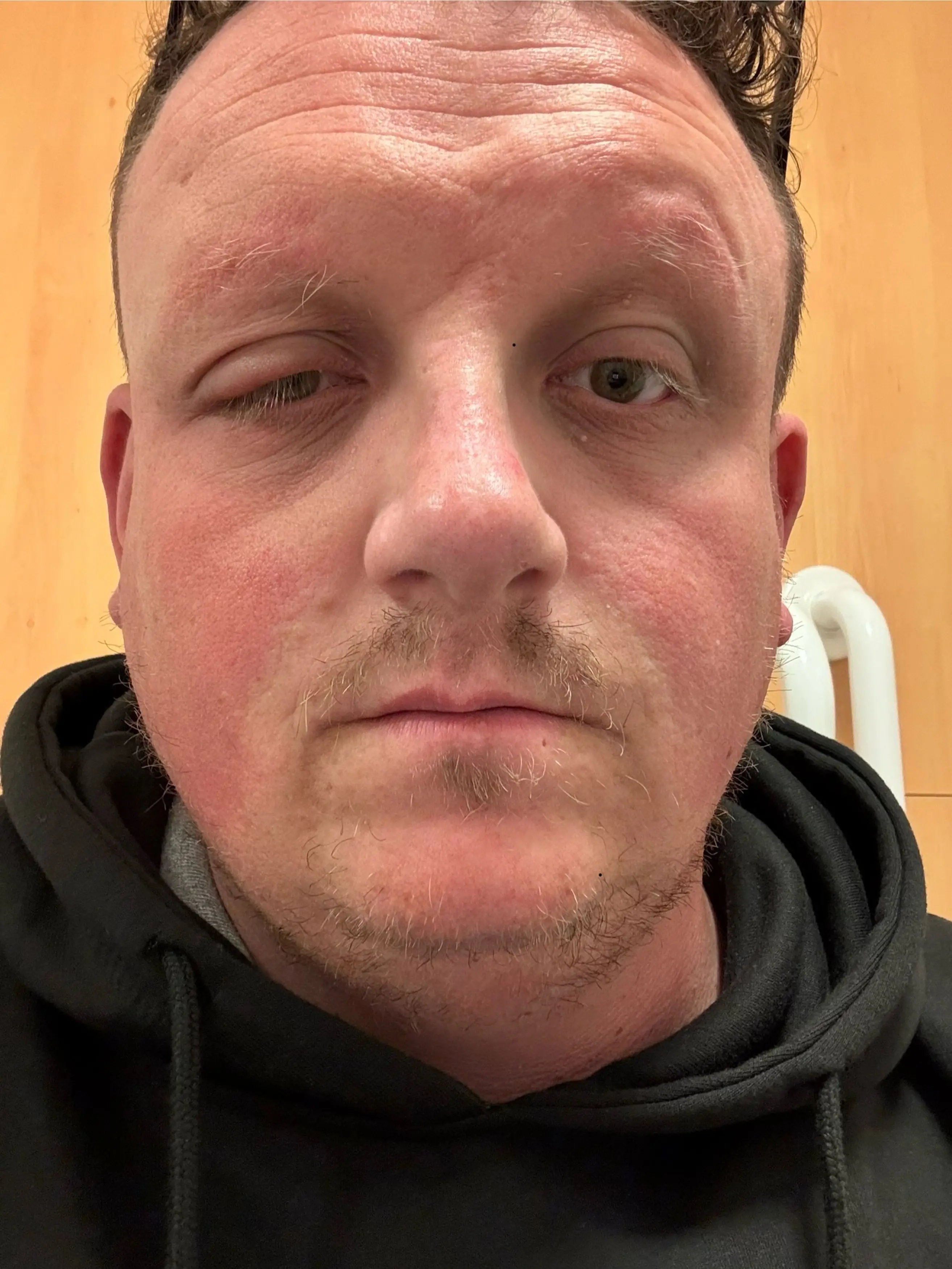 Jordan Niles woke up with a sore eye on 24 March and wrongly put it down to conjunctivitis (Kennedy News and Media)