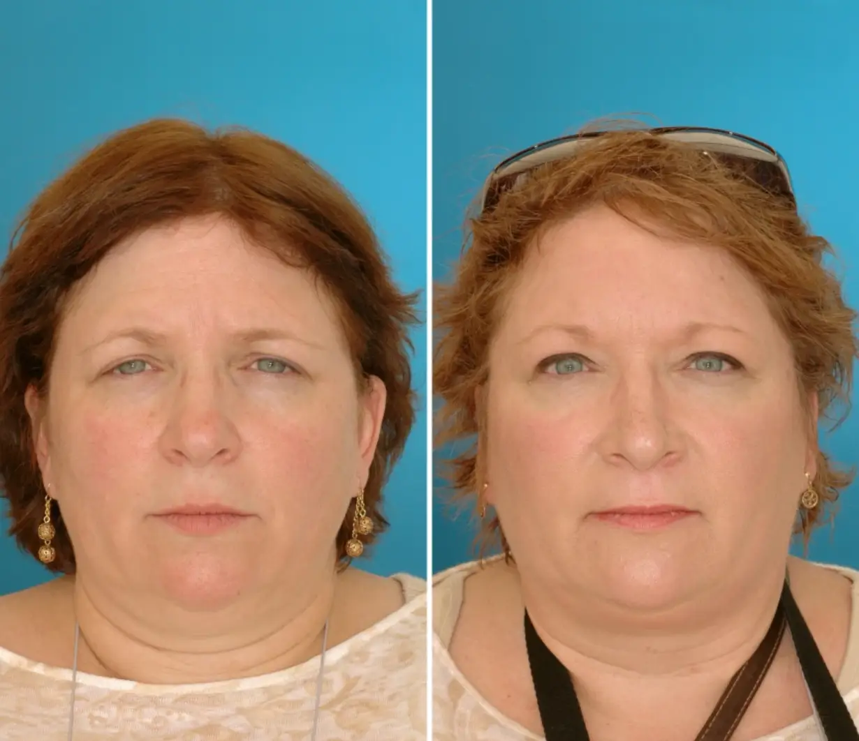 Laurie and Lisa, aged 46 (NBC)