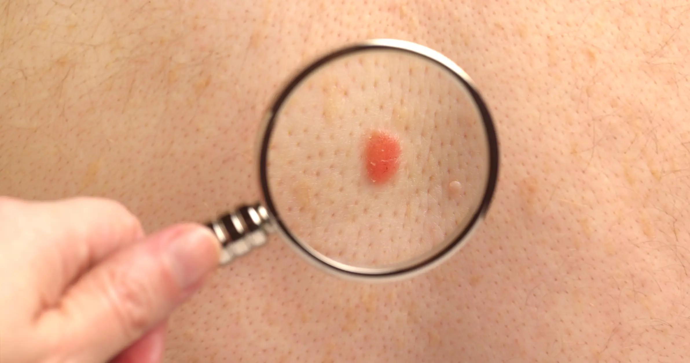 New and changing moles are one of the most known about warning signs for skin cancer. (Getty Stock Images)