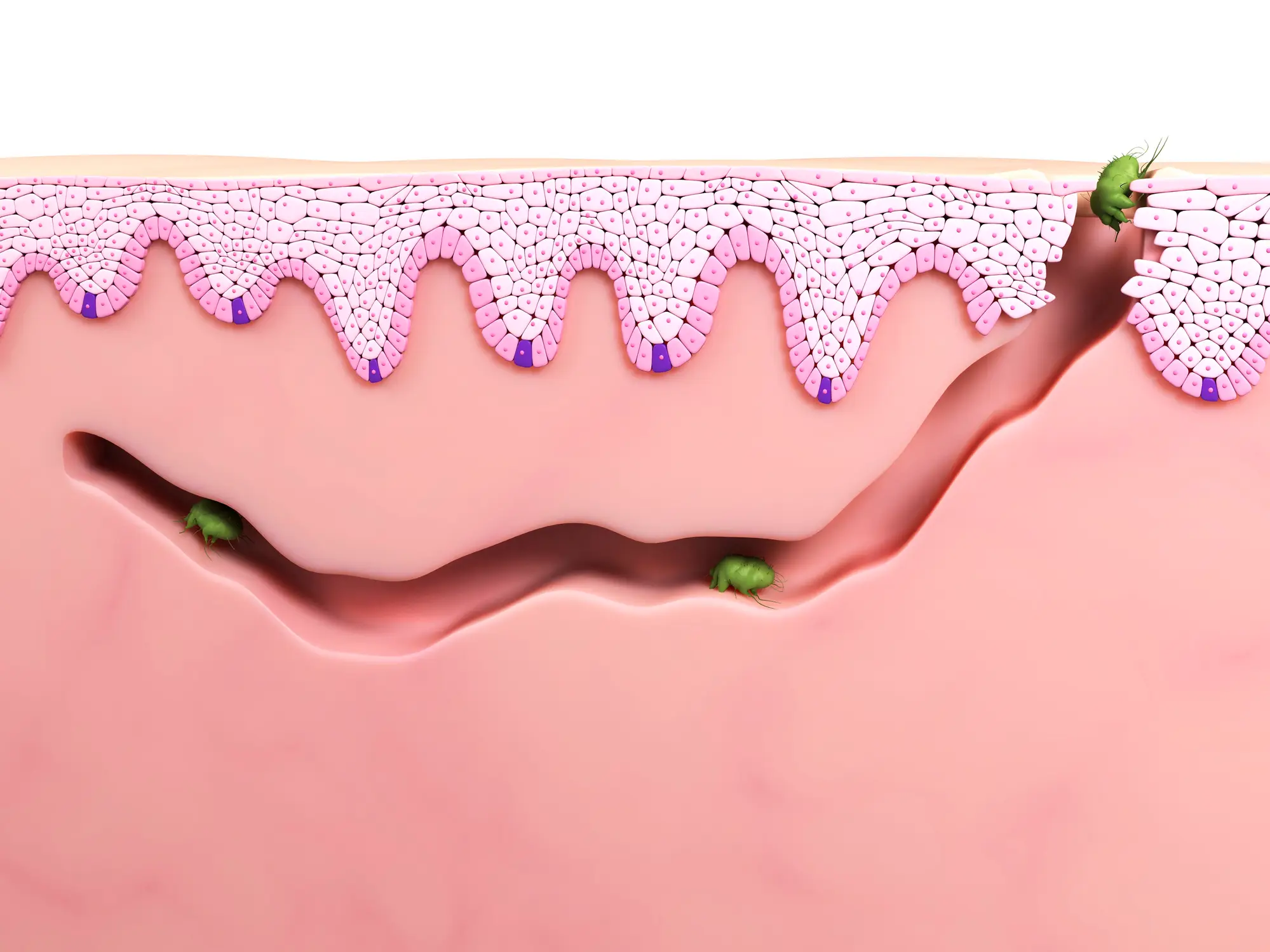 Scabies occurs when mites burrow under the skin (Getty Stock Images)
