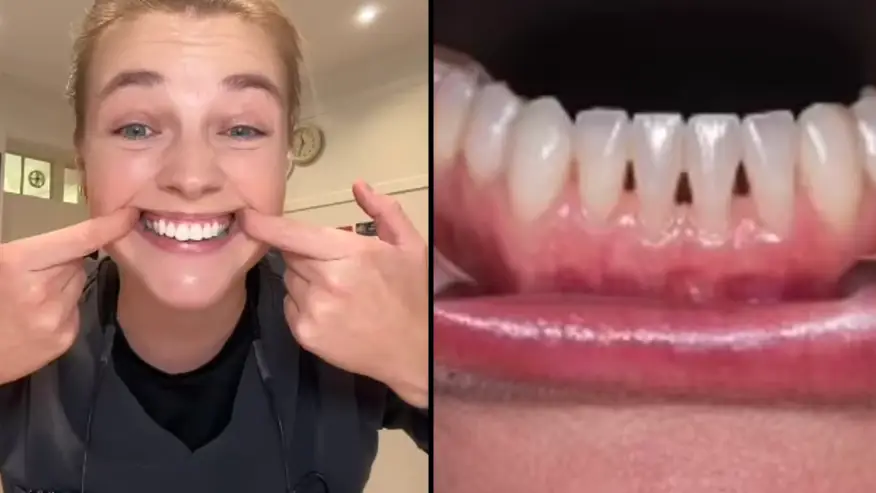 Dentist shares what it actually means if you have ‘black triangles’ between your teeth