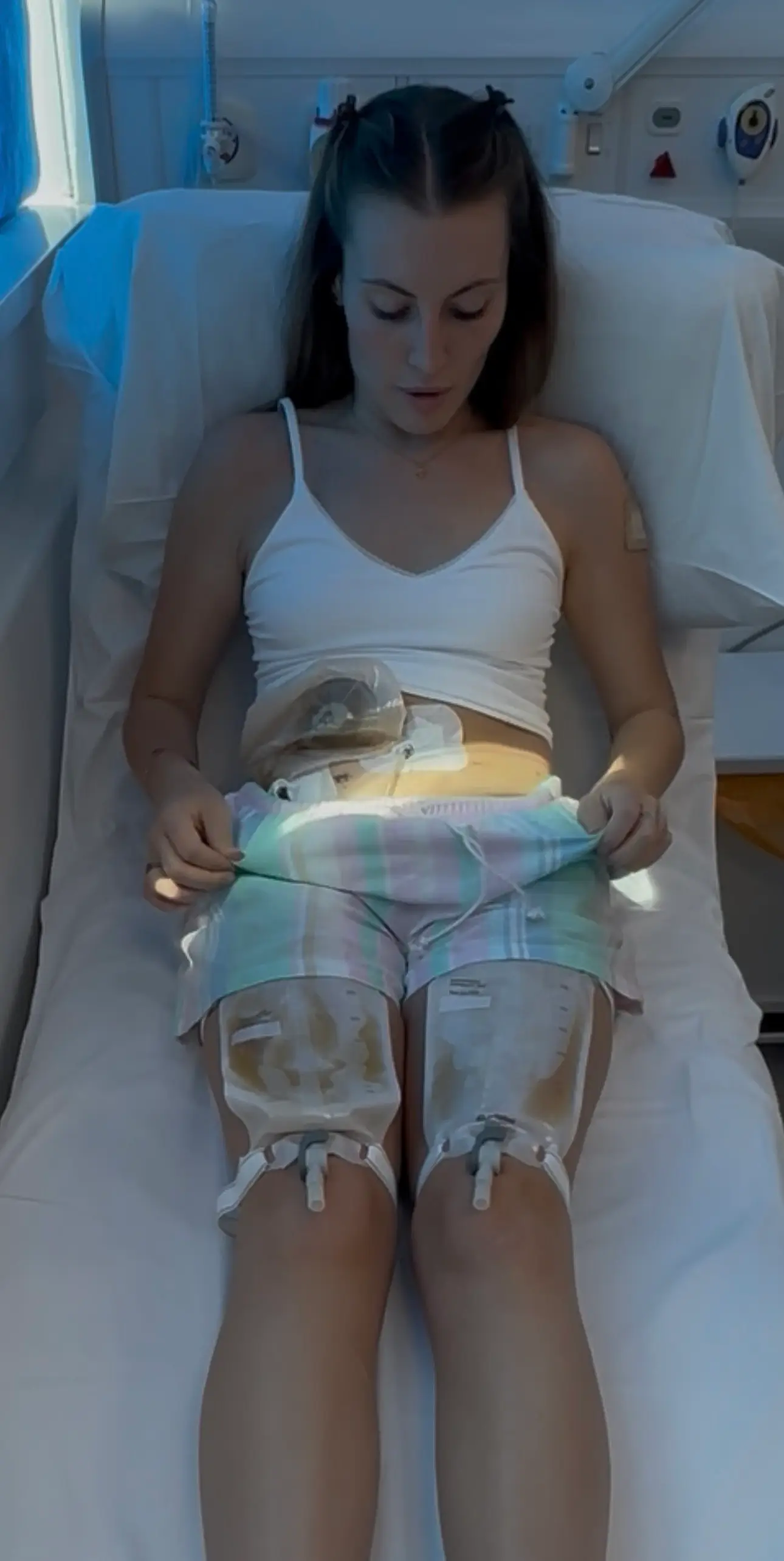 Liv's bladder was removed in an operation and she now wees through her belly button (SWNS)