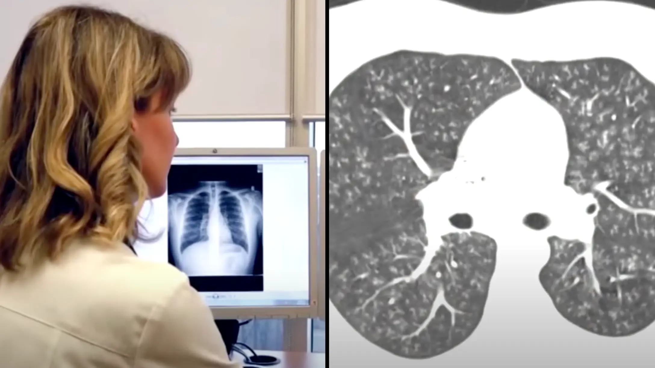 Doctor shows x-ray of 'popcorn lung' caused from vaping and it can be fatal