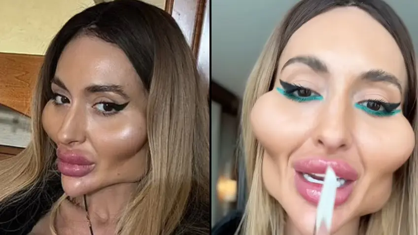 Model with 'world's biggest cheeks' shares image of what she looked like before £1,600 filler