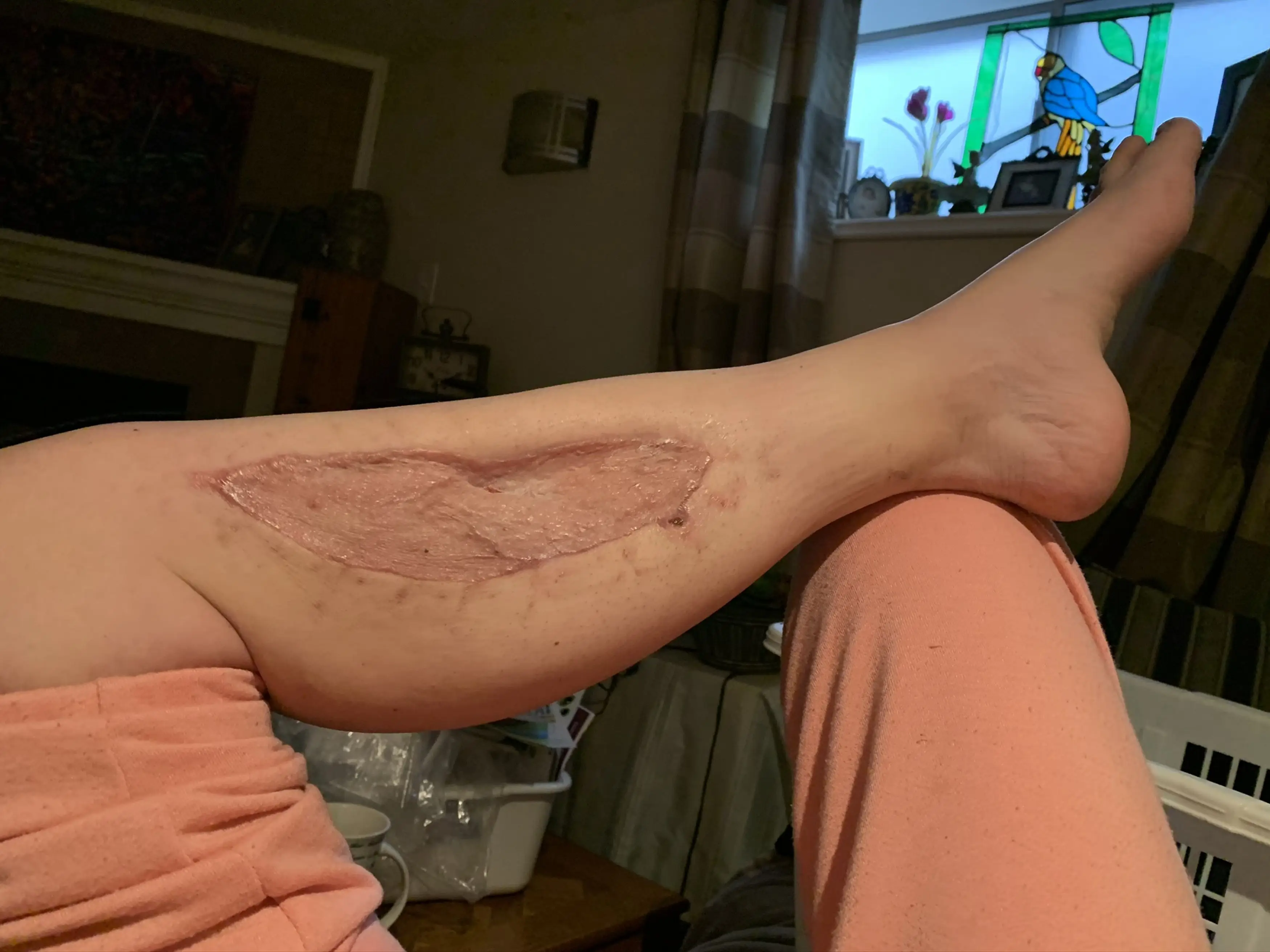 Doctors were forced to perform a life-saving operation where Julia's left leg was sliced open and muscle was cut off to relieve the swelling (Kennedy News and Media)