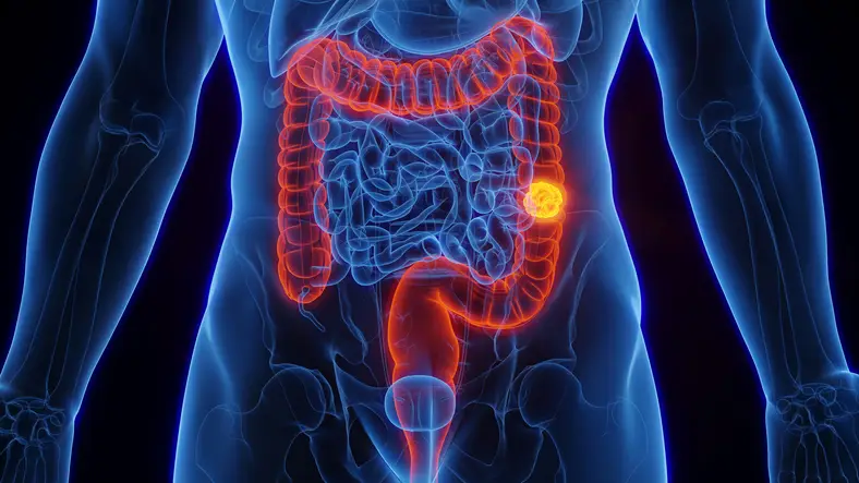 Bowel cancer cases are rising amongst young people (Getty Stock Images)