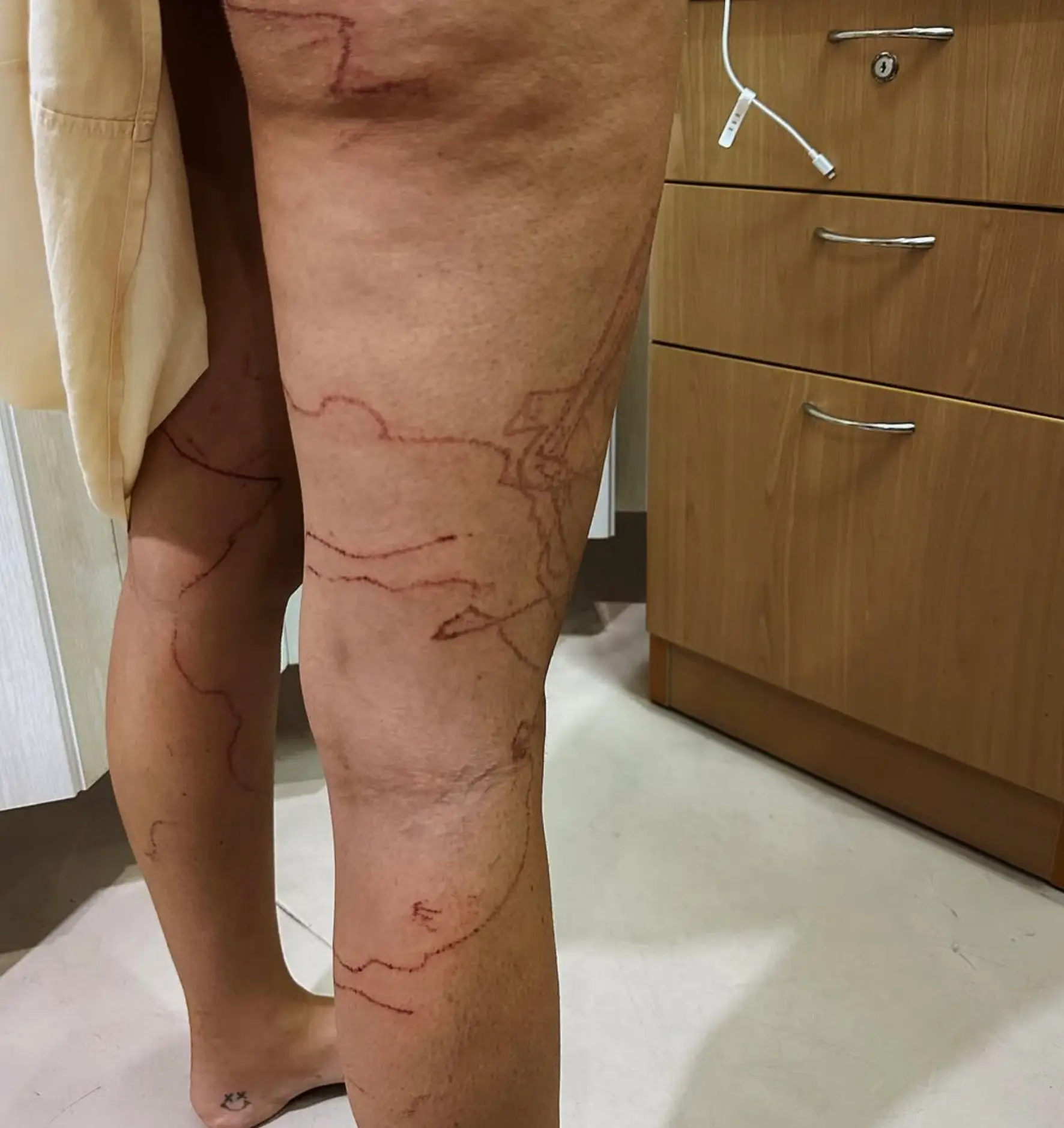 The Aussie woman has been left with scars across her body, which she says she wears 'like the finest of jewellery' (Instagram/@zoe_cahill)
