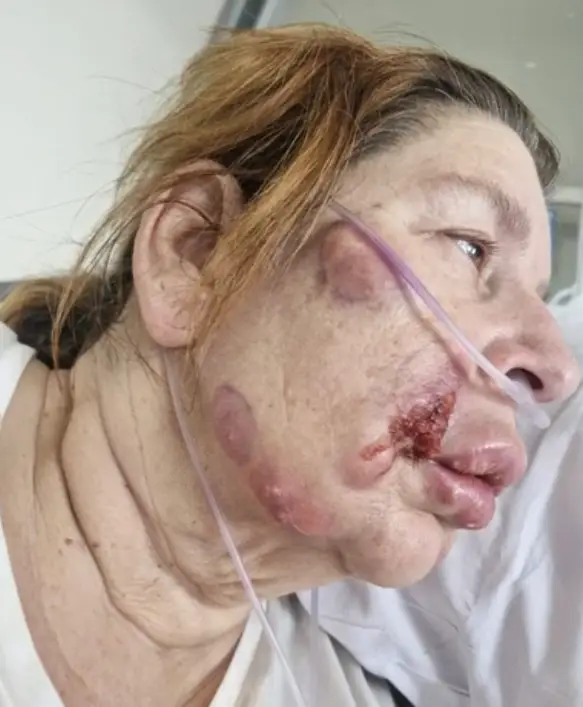 The mum contracted cellulitis (ITV/This Morning)