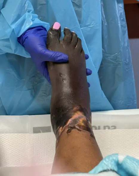 Denise's feet became 'mummified' (SWNS)