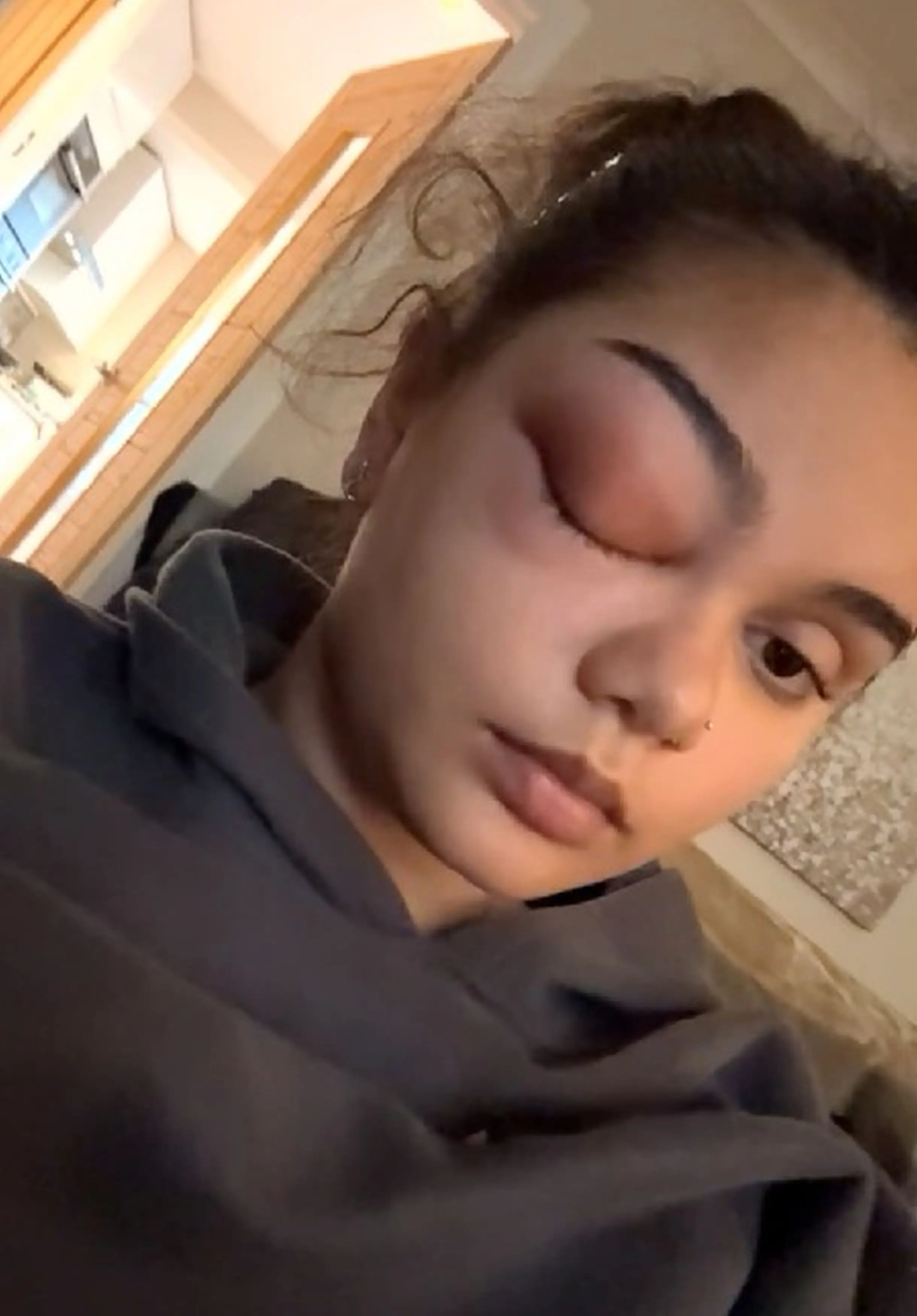 Sophie's eye 'bulged' like a golf ball (Kennedy News and Media)