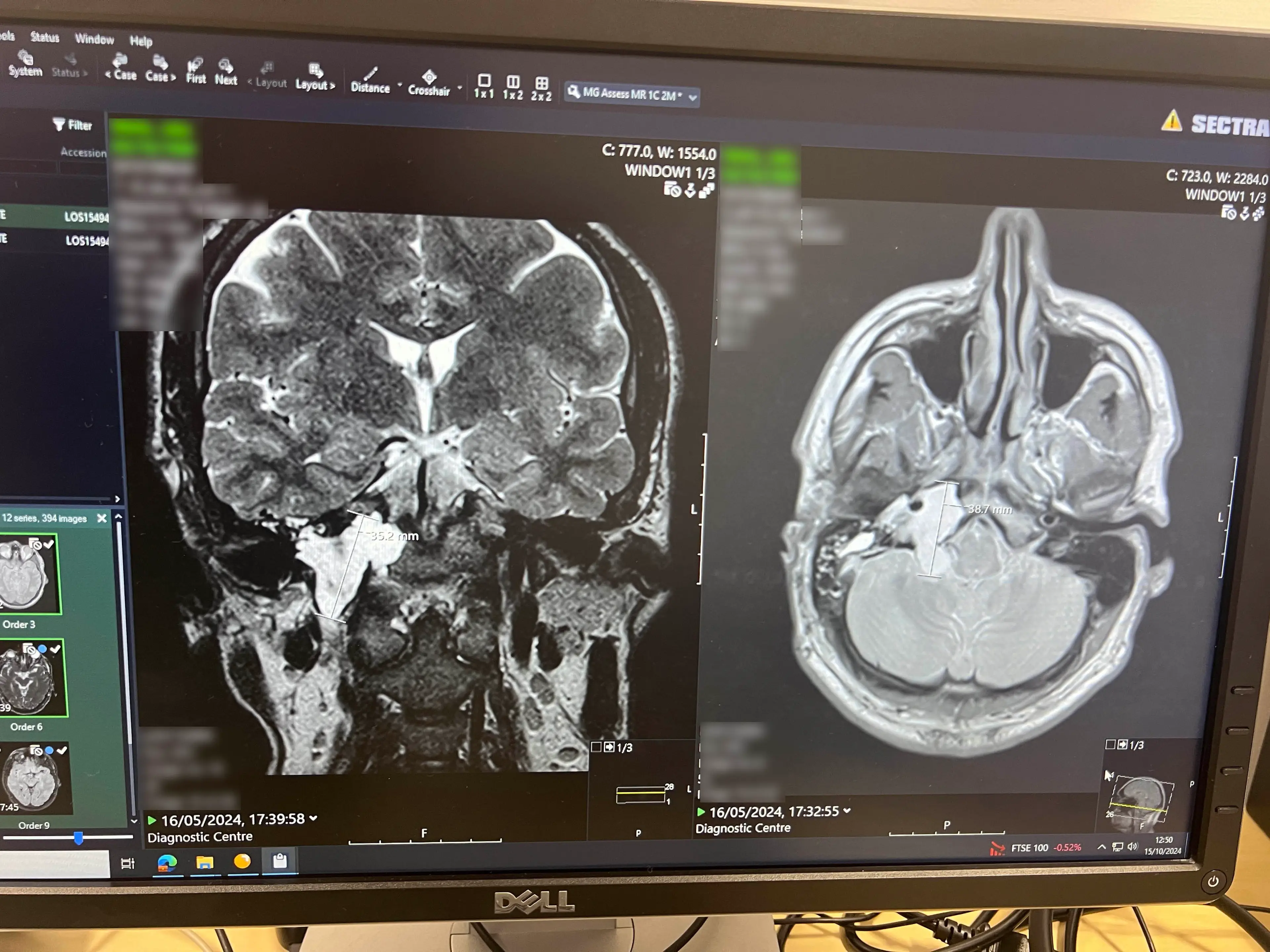 The scan of Jake's cancer (SWNS)
